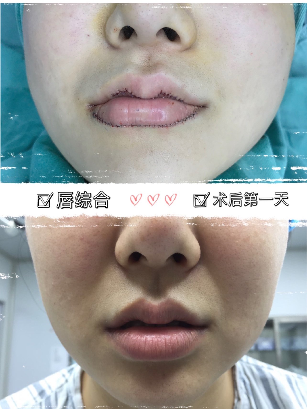 唇综合术后第一天,美唇的改变