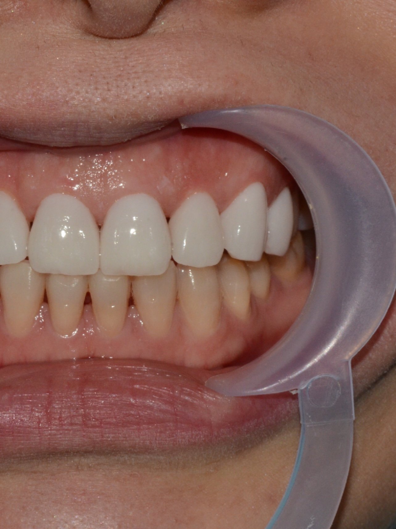 四环素牙前牙有缝隙