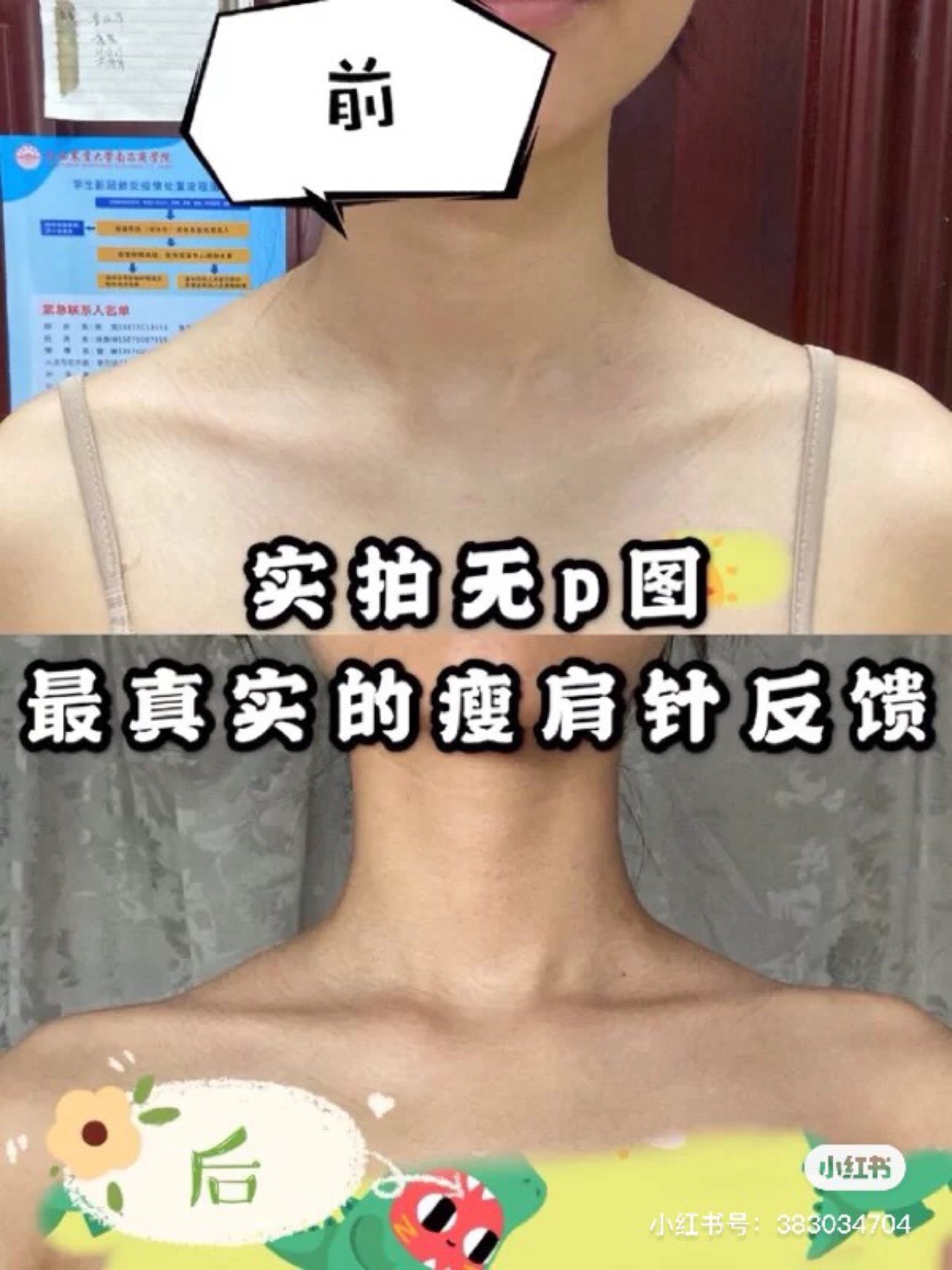没打瘦肩针前,斜方肌真是太大了,很厚,虽然不胖,但_圈子-新氧美容整形