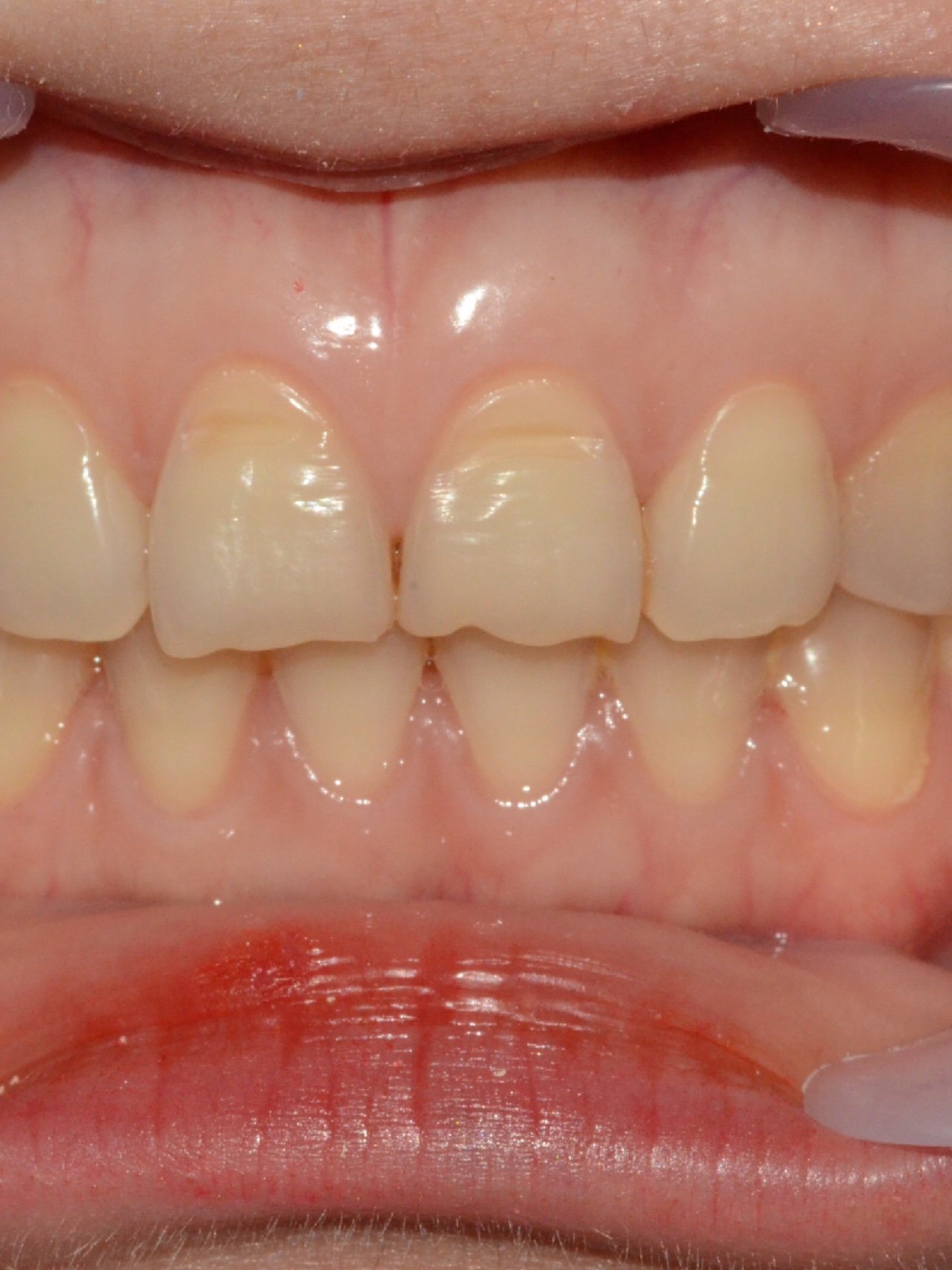 牙齿颜色黄,轻度磨损