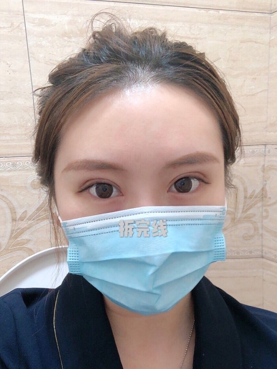 全切双眼皮日记来喽#全切双眼皮
