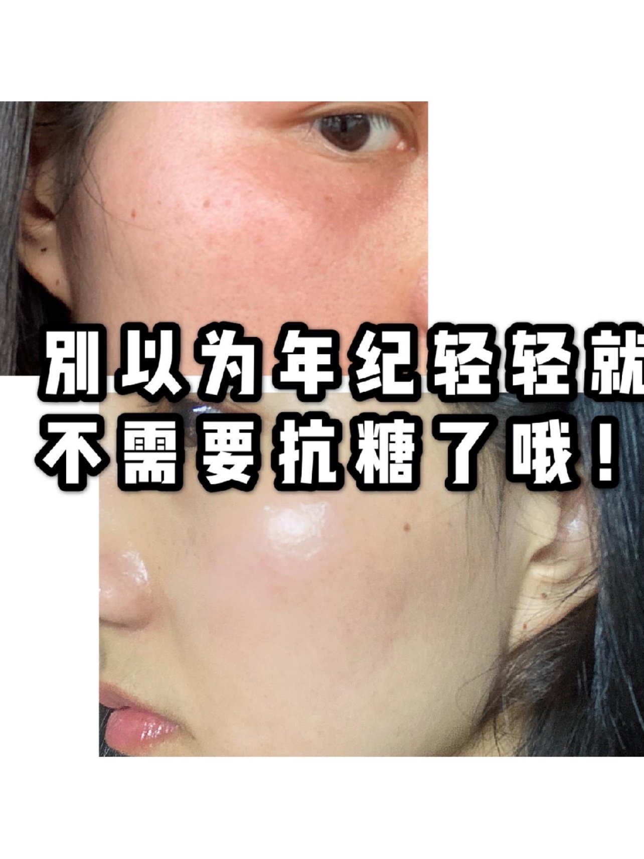 皮肤发黄? 皮肤潮红? 容易长痘? 明显,你的脸已被糖化了!什么是糖 ??