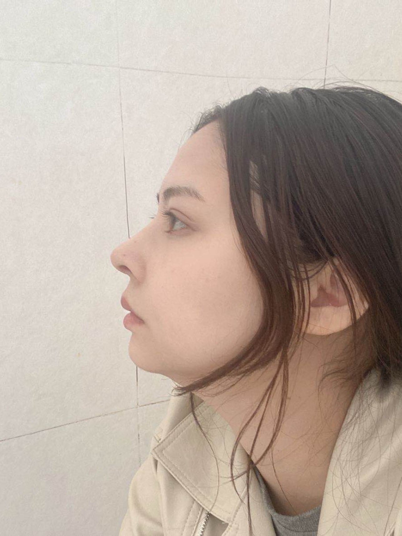 肋骨鼻的第21天,正面有些许肿胀,侧面基本看不出来_圈子-新氧美容整形