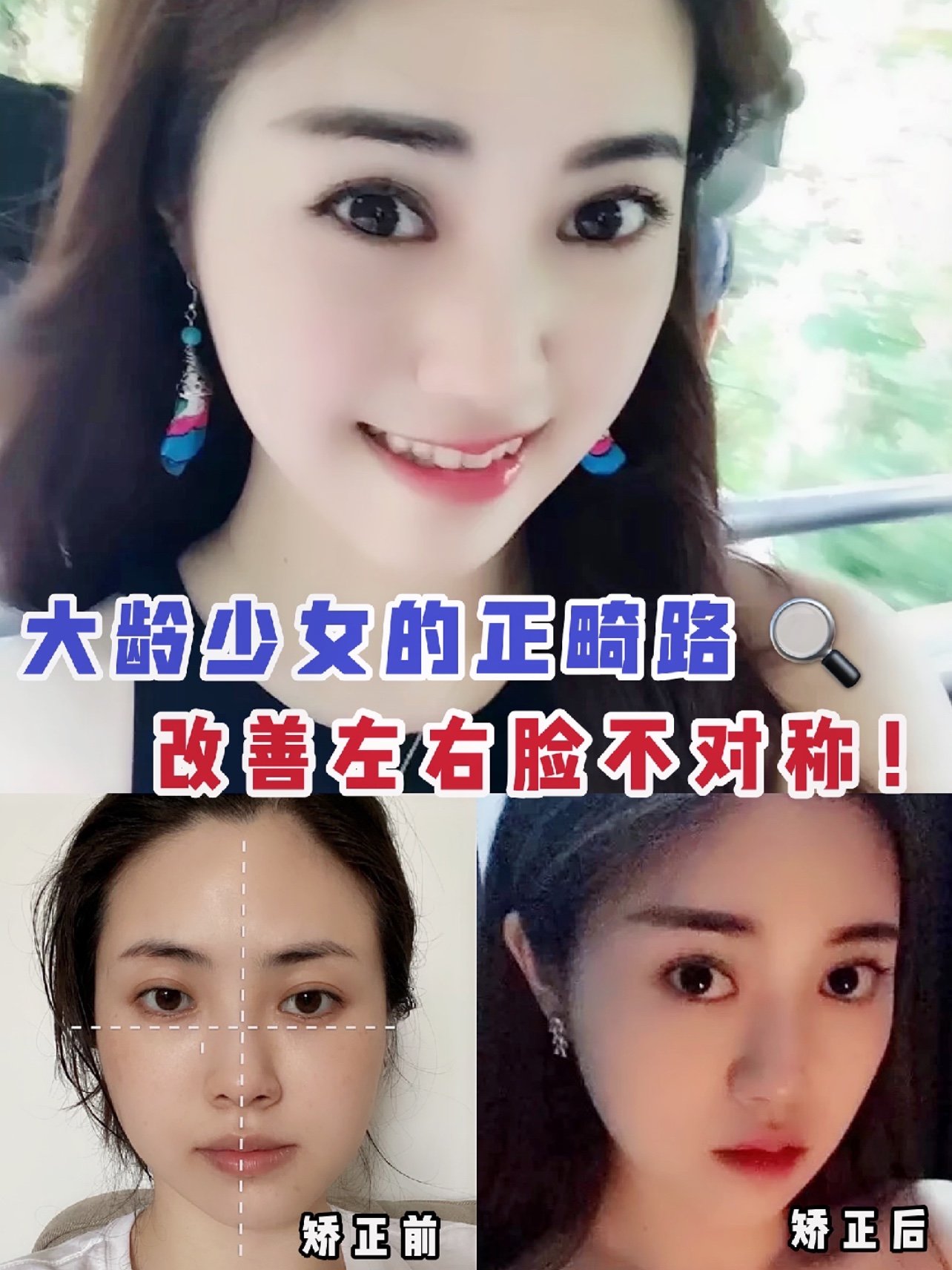 大齡少女的正畸路,改善左右臉不對稱