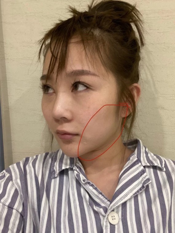 应该有很多集美们和我一样,都有一个困扰,平时腮部看_圈子-新氧美容