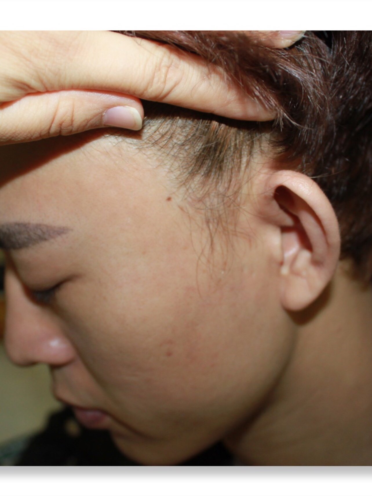 男人就是要有鬓角才行!发际线现在1年多了恢复的很不错.