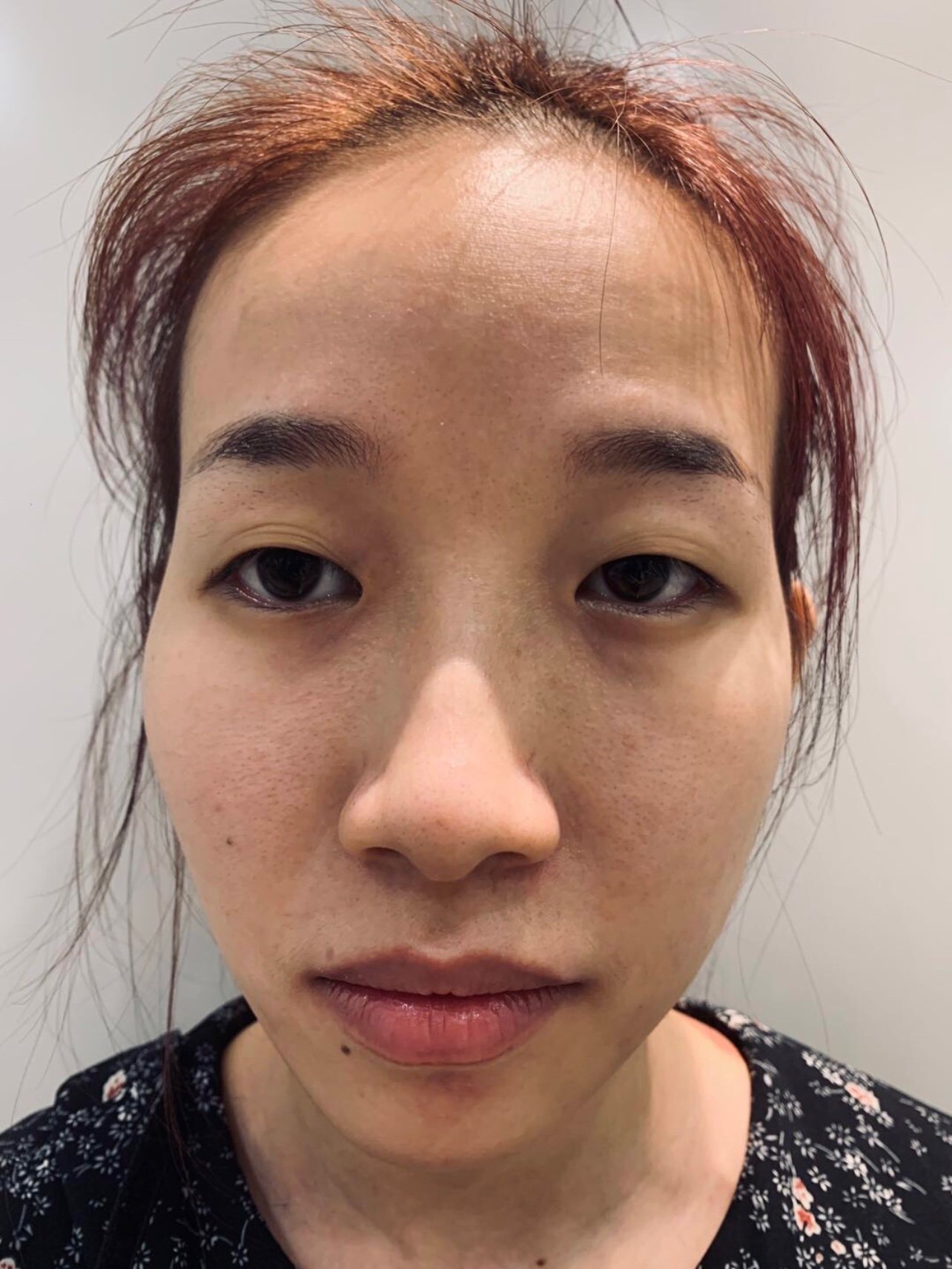 我手术前有多层眼皮,就是上眼睑松弛导致的,我就想着_圈子-新氧美容