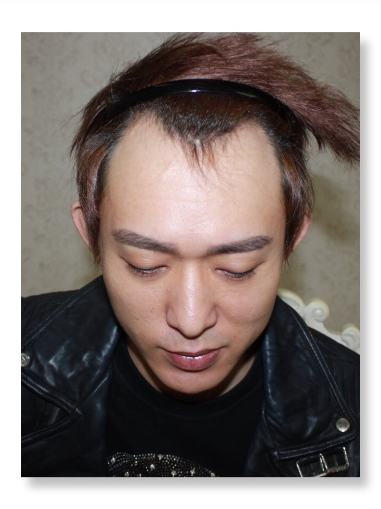 男人就是要有鬓角才行!发际线现在1年多了恢复的很不错.