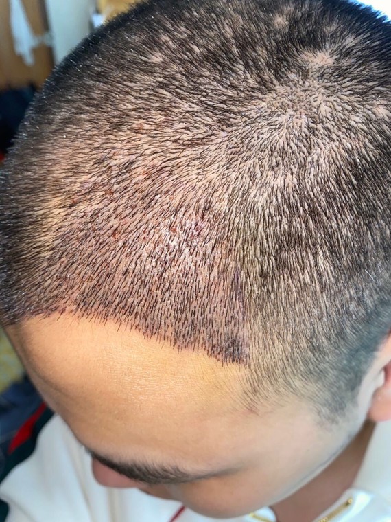 今天是植发后第五天,去医院清理了血痂,洗了头.