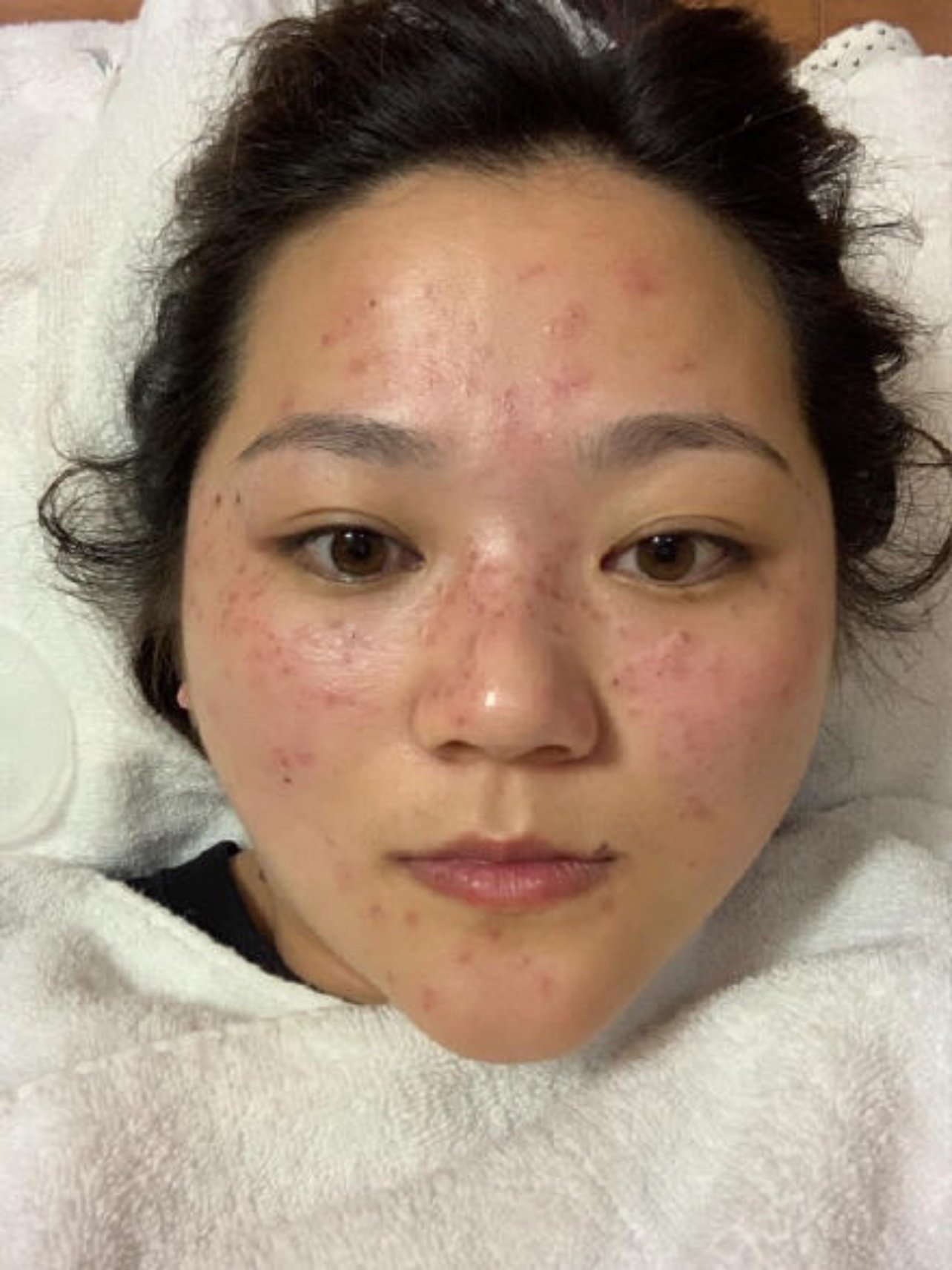 纯素颜斑点不是太深,没想到仪器一测,深层斑点多到我_圈子-新氧美容