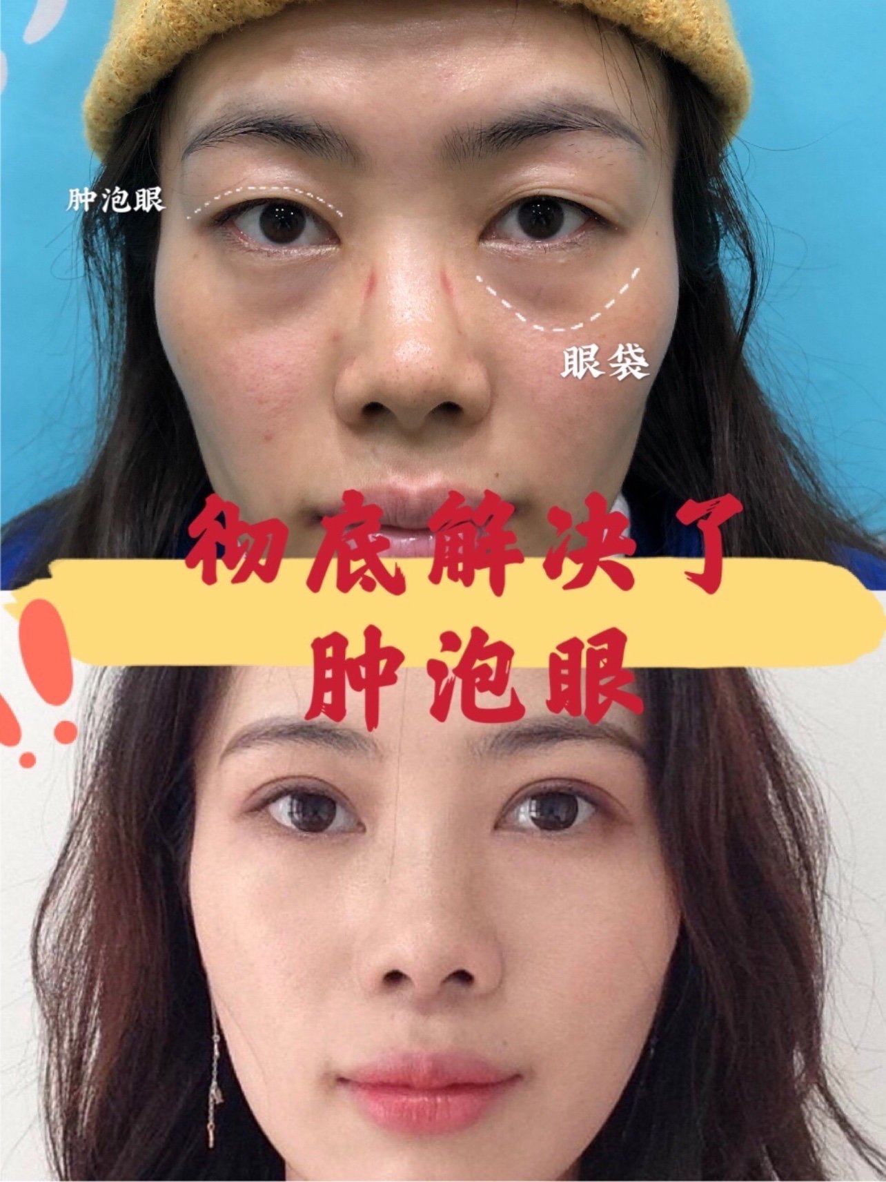 彻底解决了肿泡眼感觉人都变漂亮了