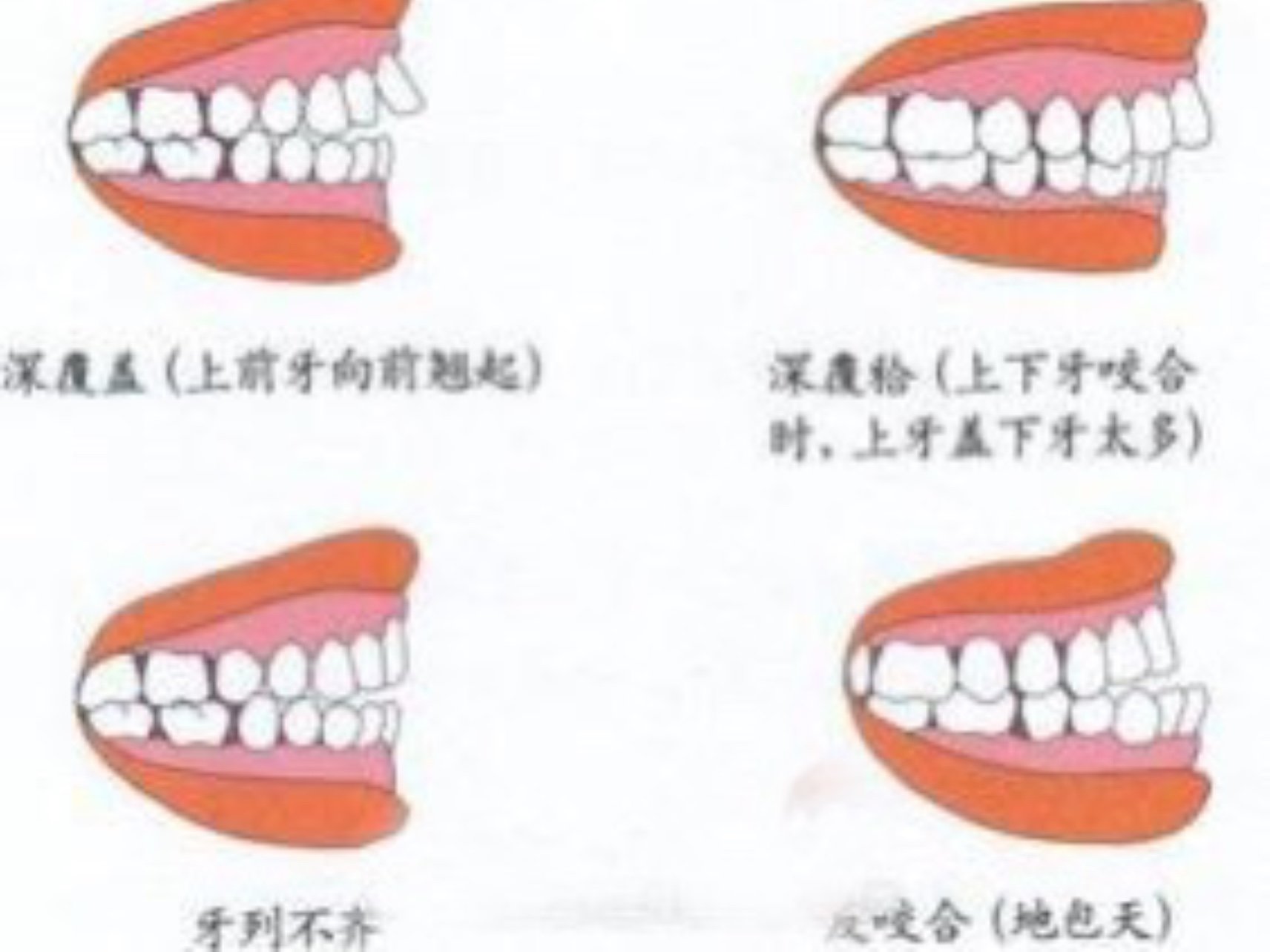 牙齿反合被称为"后牙反合",表现为下侧磨牙包住上侧磨牙,造成咬合不正