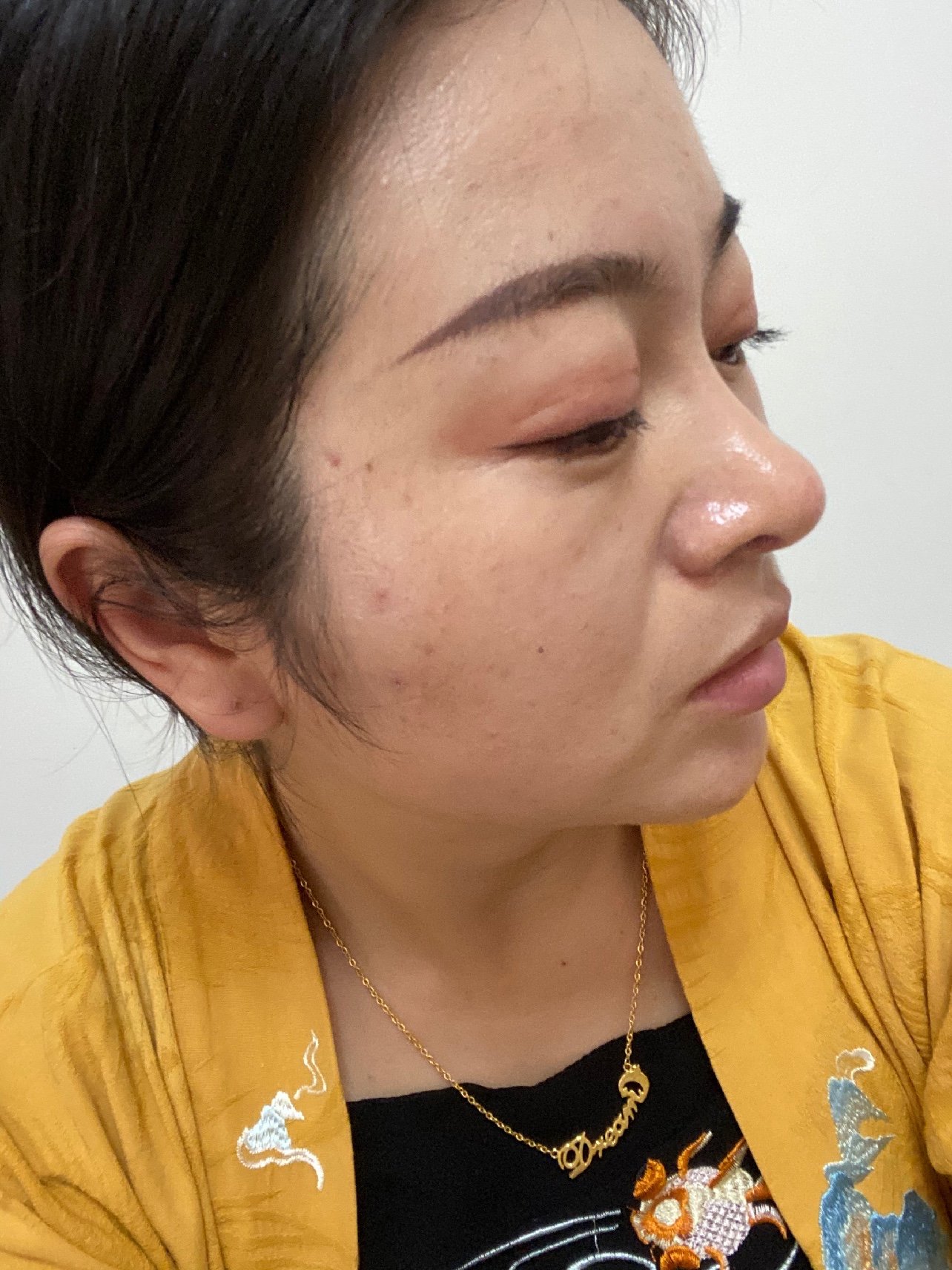 这是目前为止的面部线雕和鼻部多项两个月多的效果,线雕_圈子-新氧