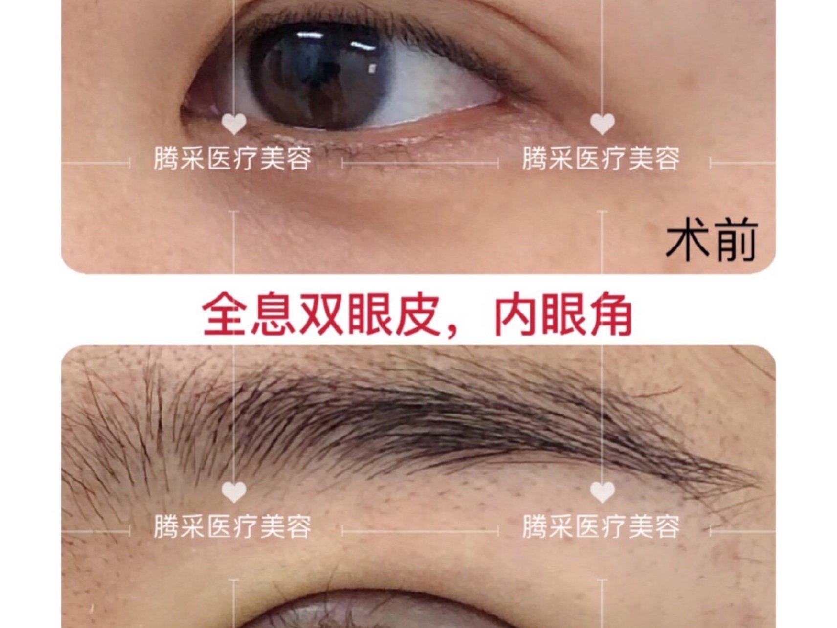 整形美容双眼皮术前消毒（整形美容双眼皮术前消毒多久） 整形美容双眼皮术前消毒（整形美容双眼皮术前消毒多久）《双眼皮术前消毒顺序》 整形美容