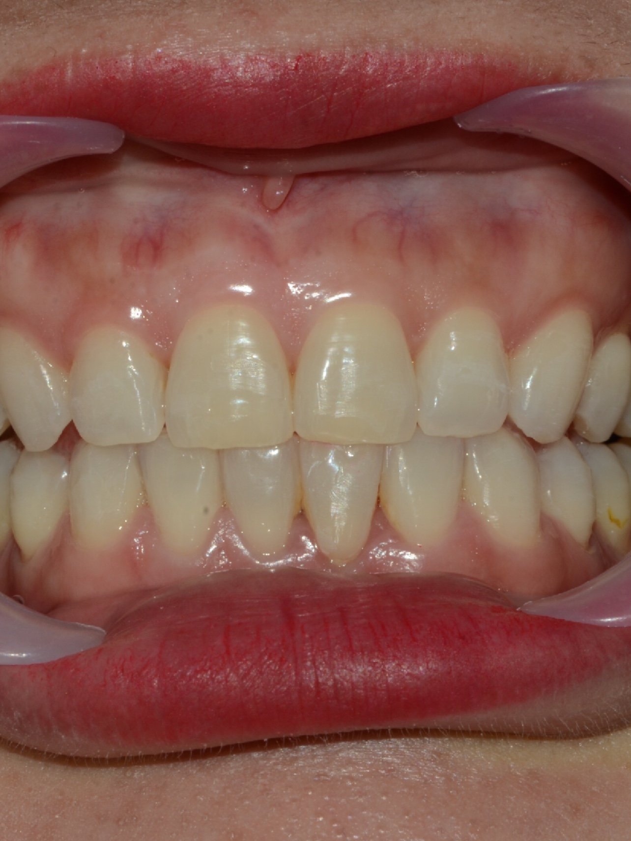 深覆合牙齿内倾