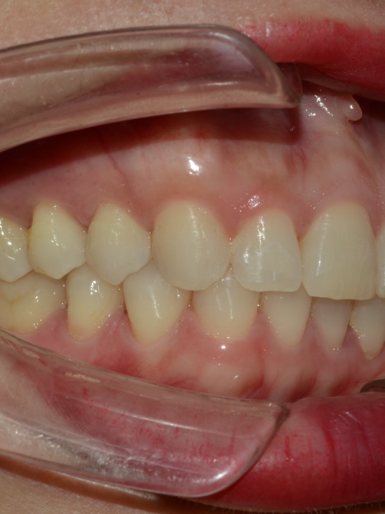 深覆合牙齿内倾