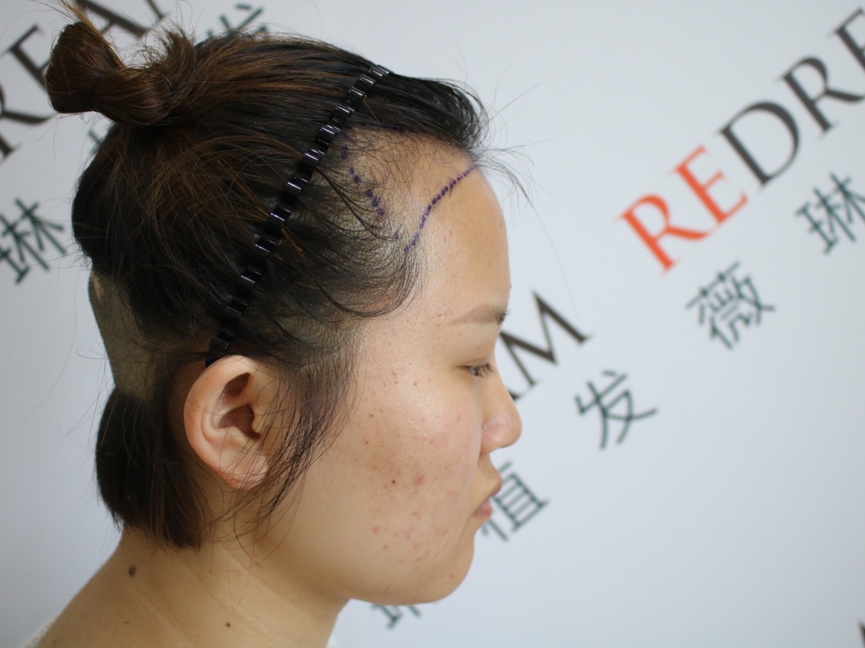 天生的m型缺发,显得额头很大,很少会把头发扎着,感觉发际线再