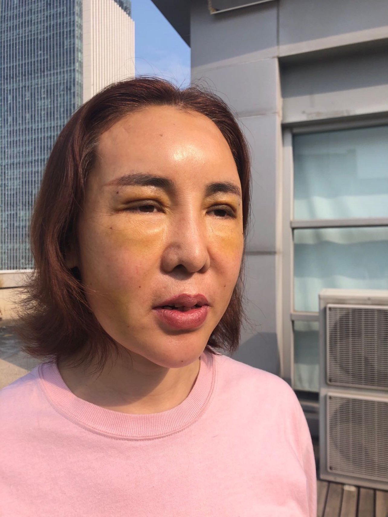 做完填充的第5天,脸部还是非常的肿胀.