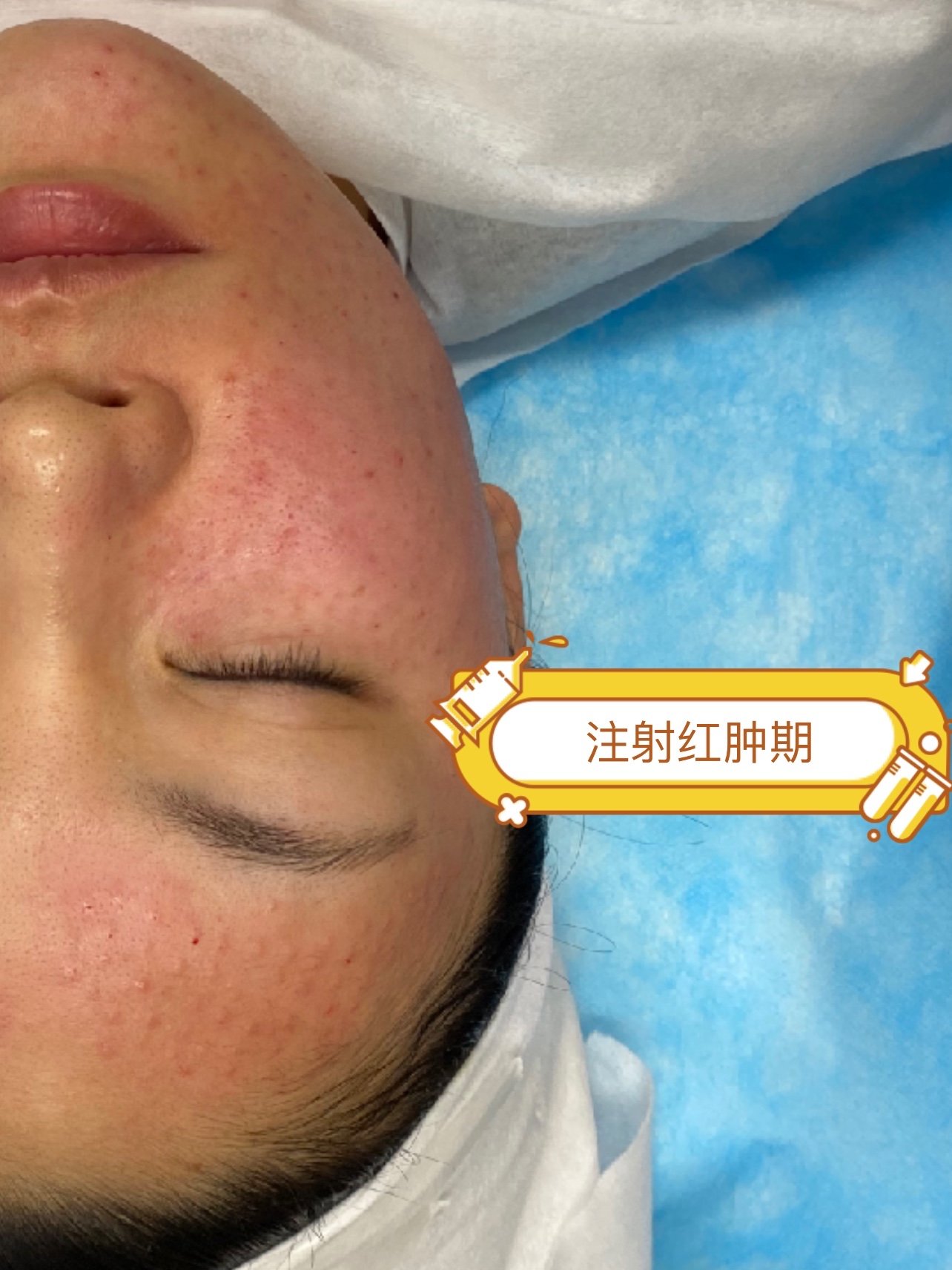 超级水光手针注射是什么体验?