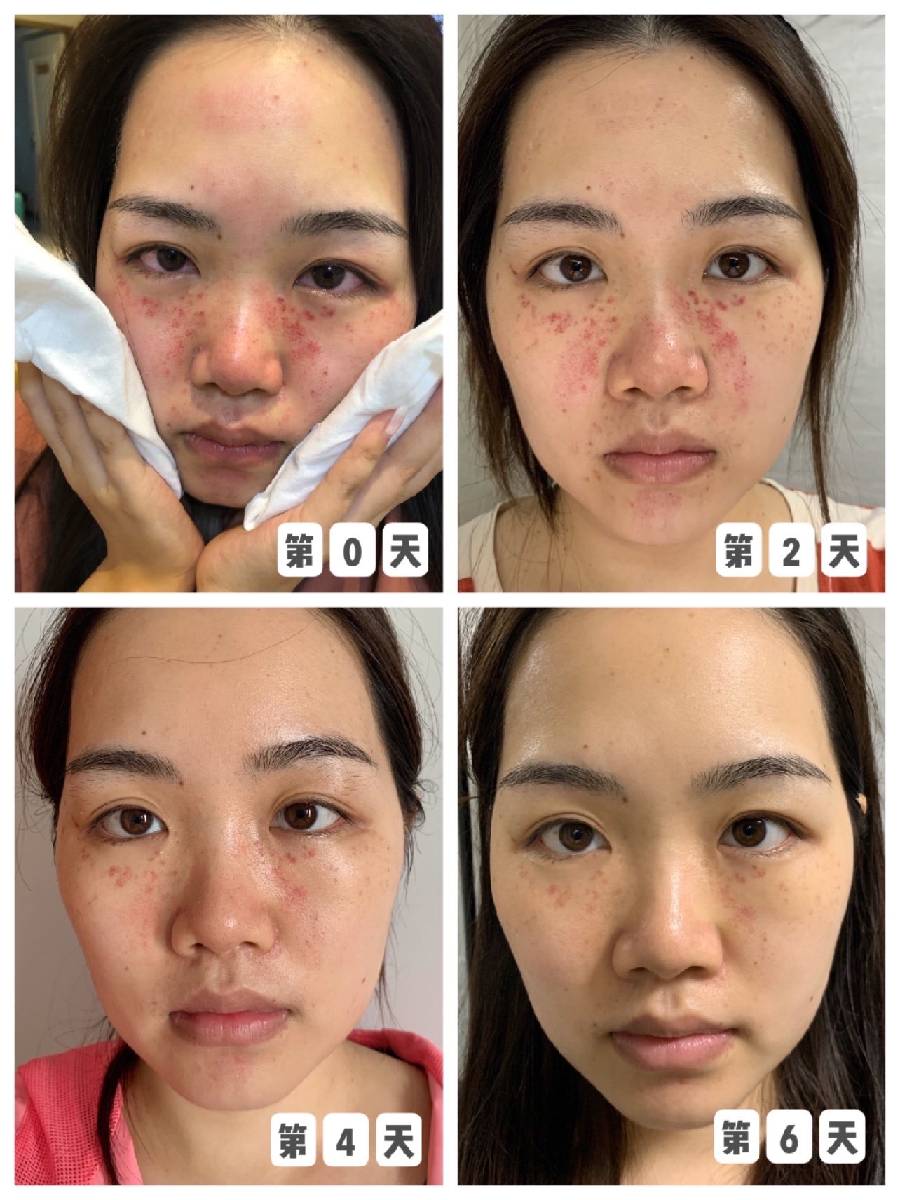 82超皮秒体验后附注意事项反馈来啦啦啦82