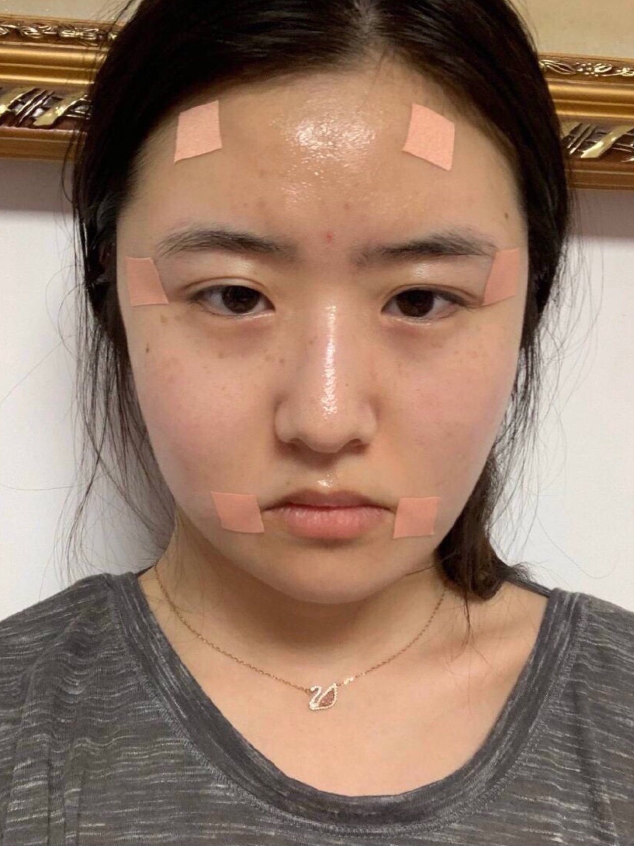 我的脸呢就是干干瘪瘪的别人以为我是营养不良之前刚做完的时候很肿也