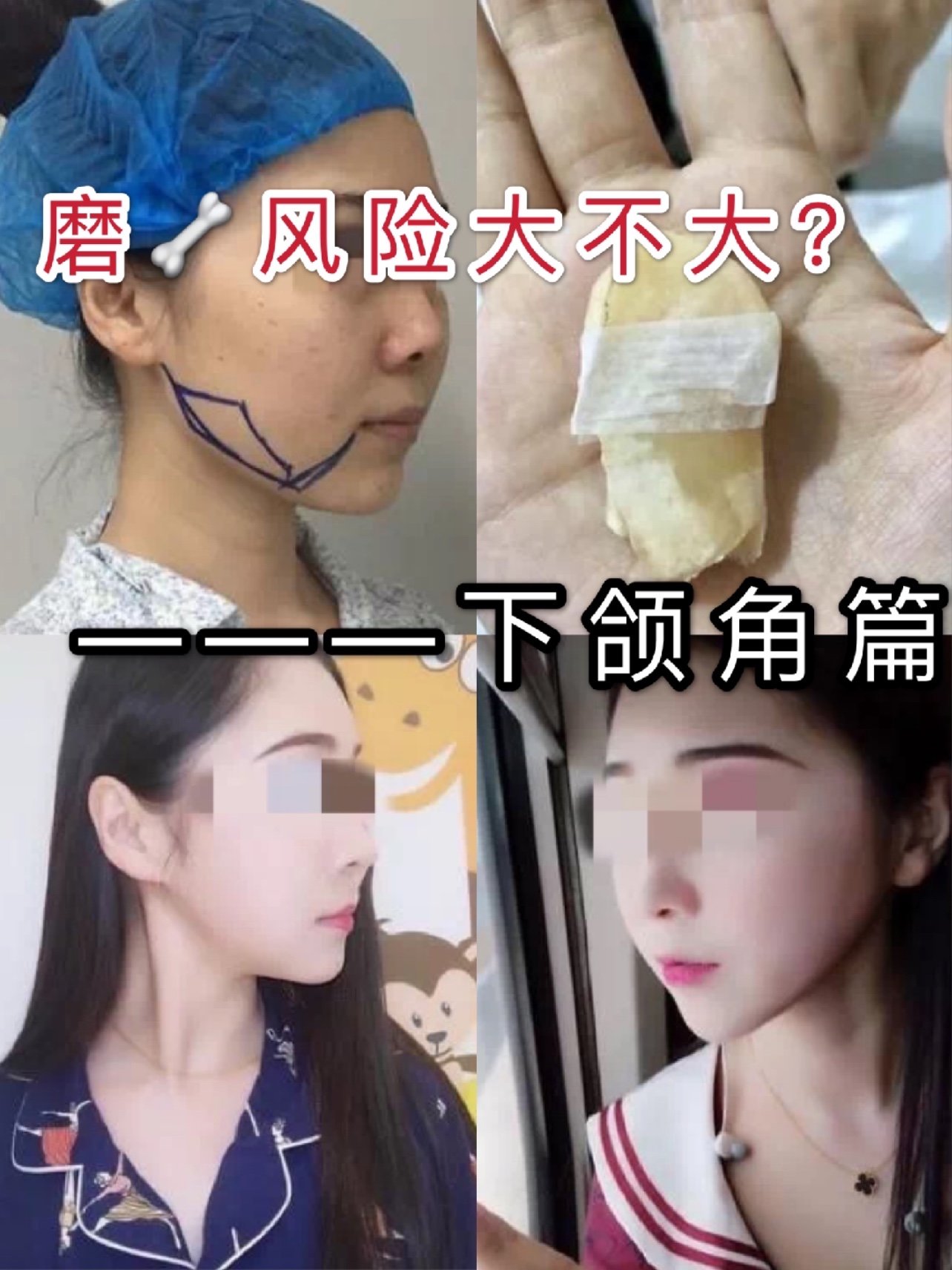 审美应该多元化) 一些方脸的妹子有些下颌骨比较宽的宝宝们通过削骨