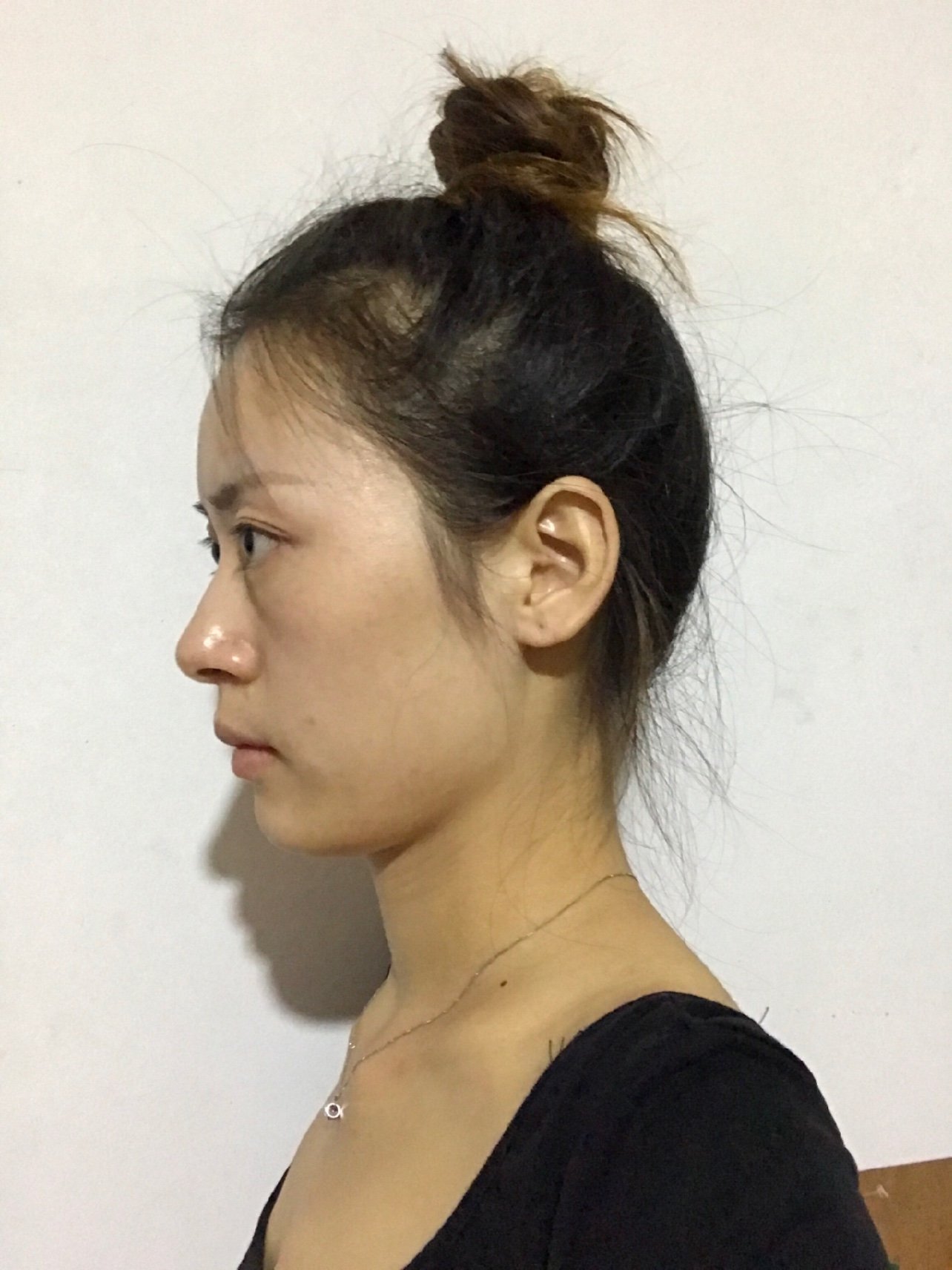 这是我素颜的样子,颧弓宽而且整个脸看不起凸凹不平的_圈子-新氧美容