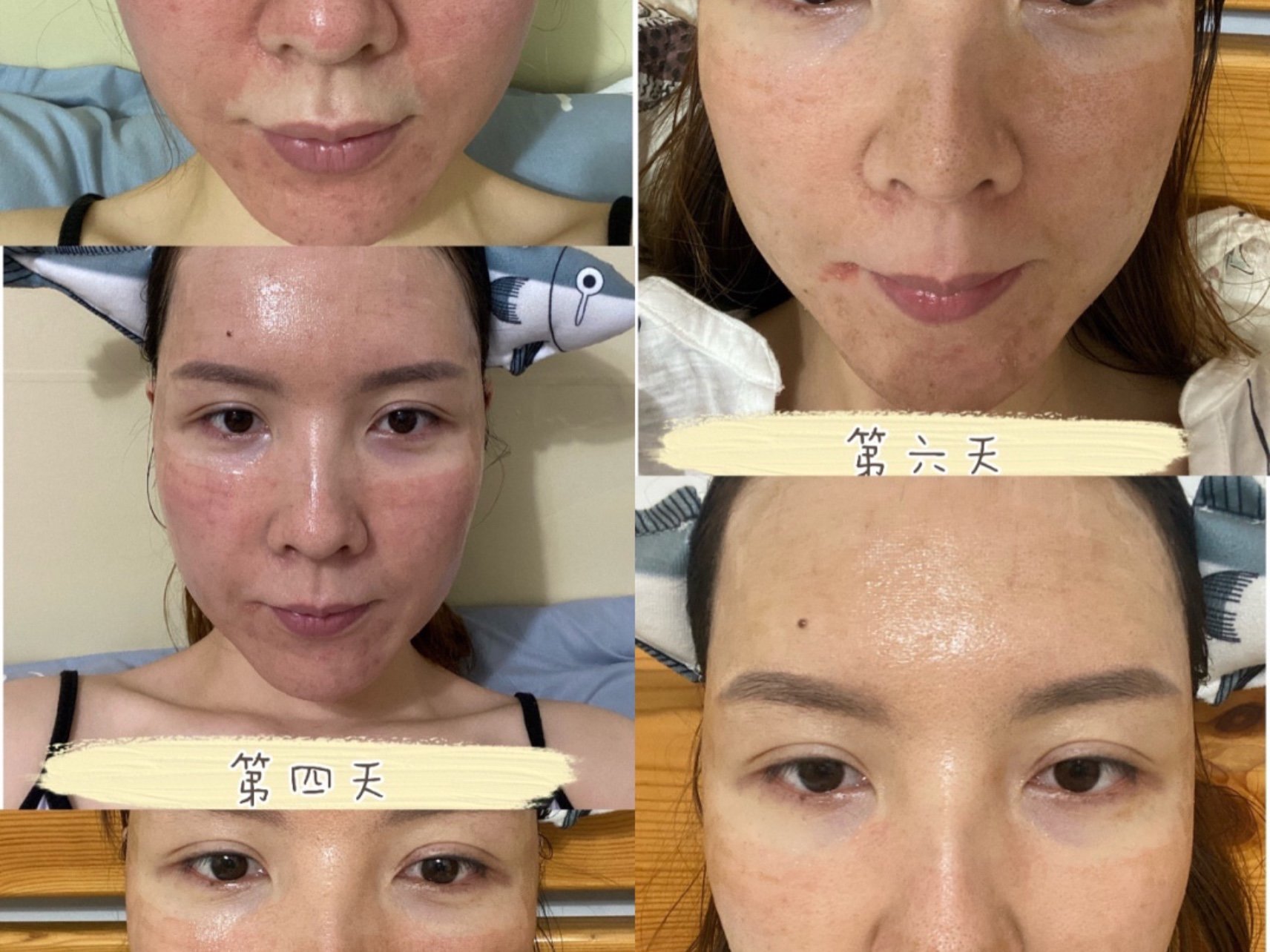 新氧试用官19天后的点阵激光对比图来袭09