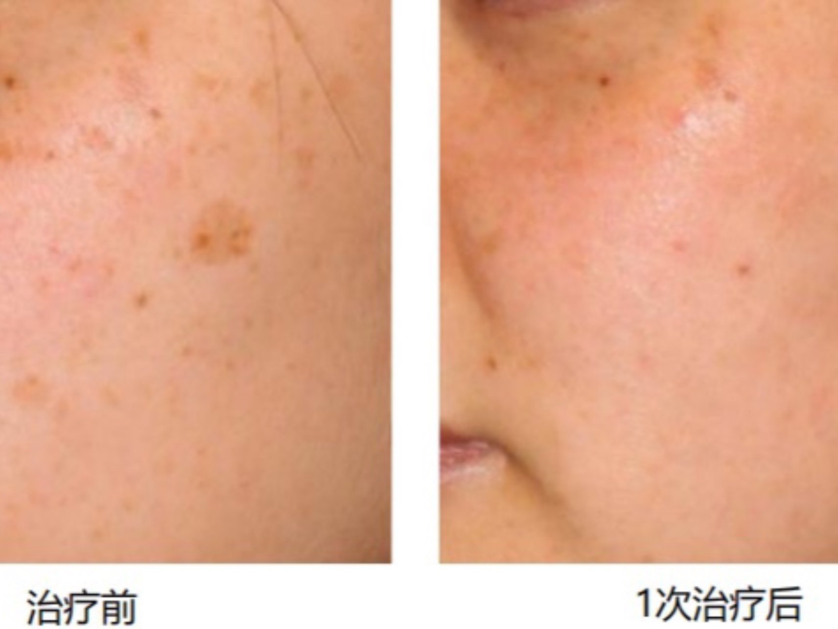 picoway 532nm皮秒激光在日光性黑子治疗上的优势主要体现在