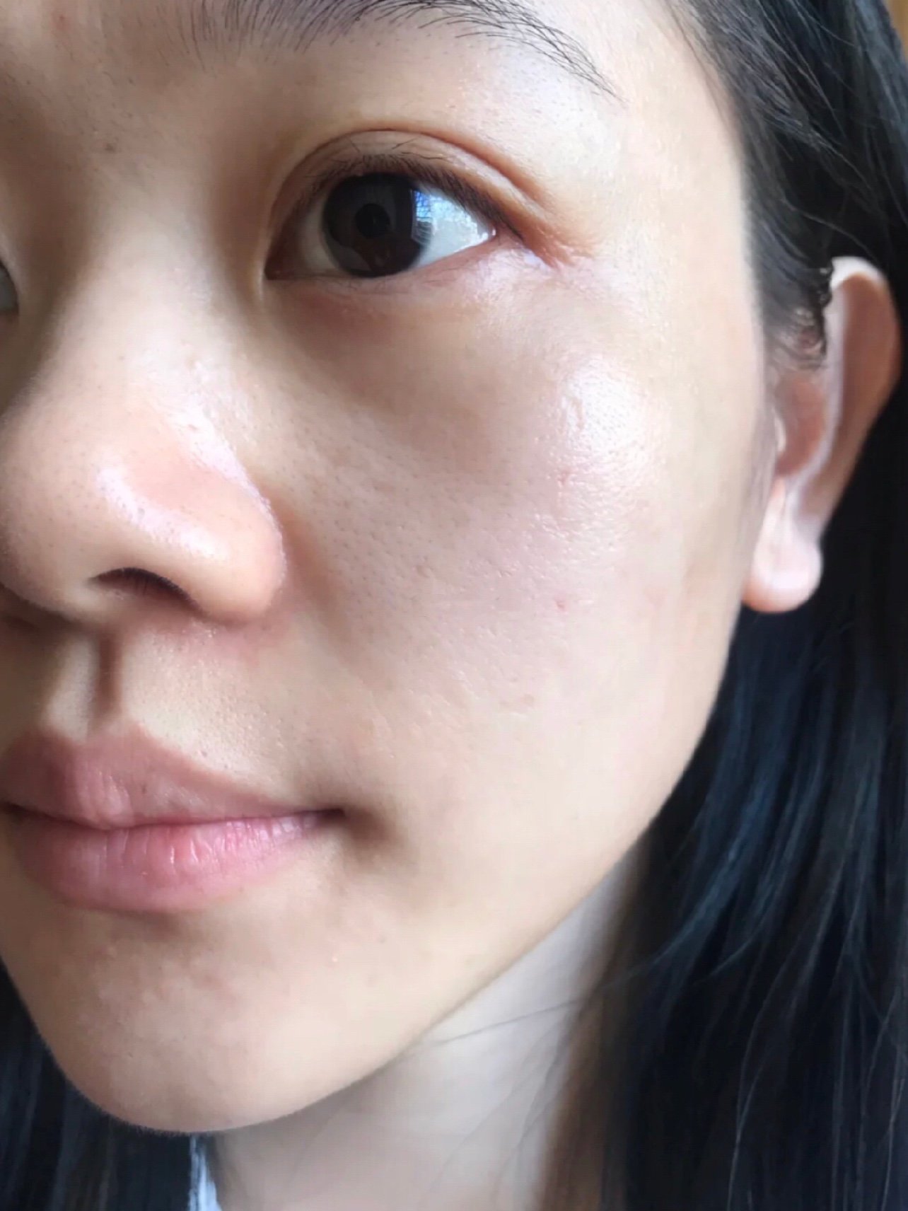 素颜超皮秒两个月后,反黑中,可能是最近熬夜,反黑比较明显,要