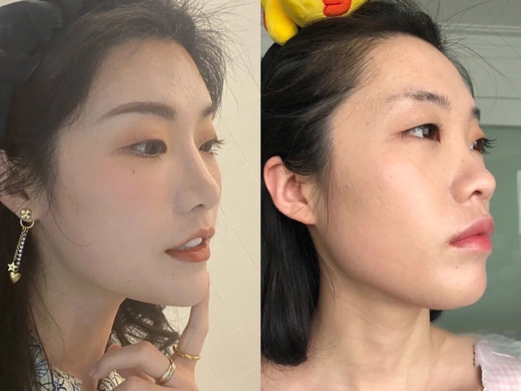 塌塌鼻很没有气质,一直想要用玻尿酸垫一下鼻子…新氧_圈子-新氧美容