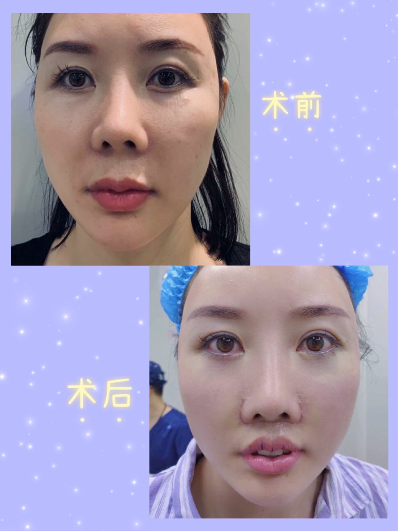 我的人中特别长,而且完全没有人中沟,显得年纪大老气_圈子-新氧美容