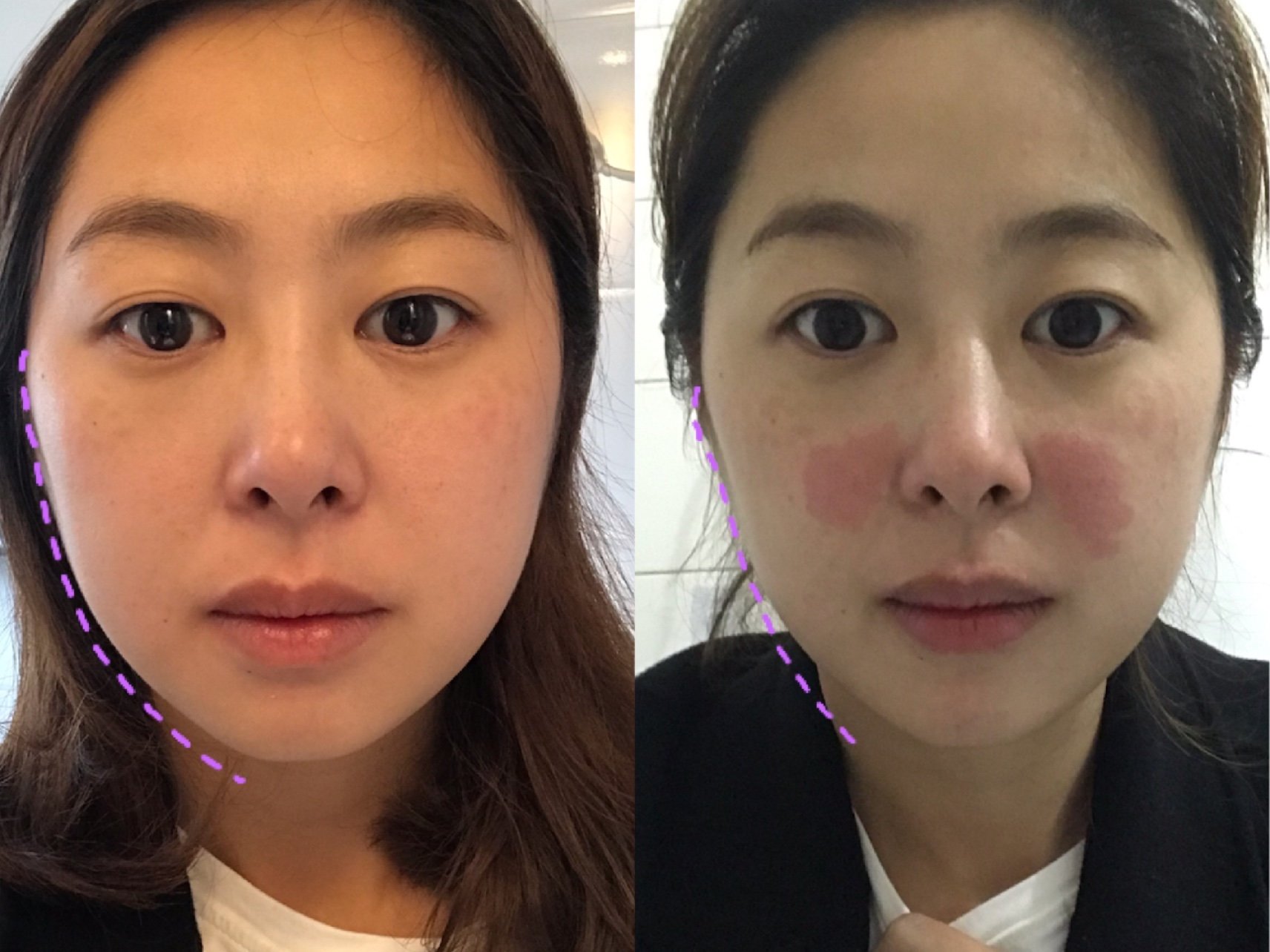 fotona 4d初体验,挑战2小时紧致抗衰!