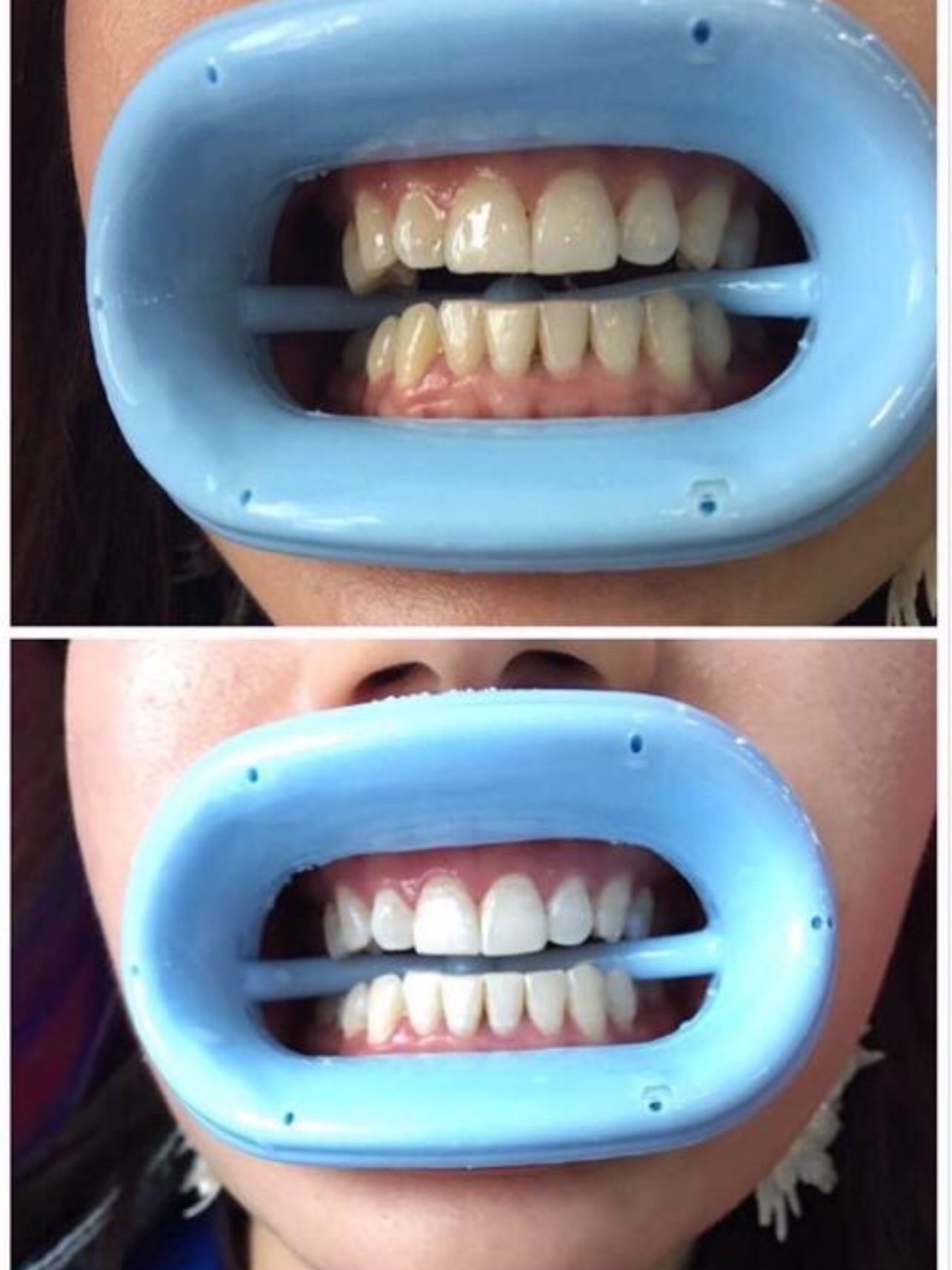 想美白牙齿挺久了,新氧上看了网友好多讨论后决定来试试皓齿美白