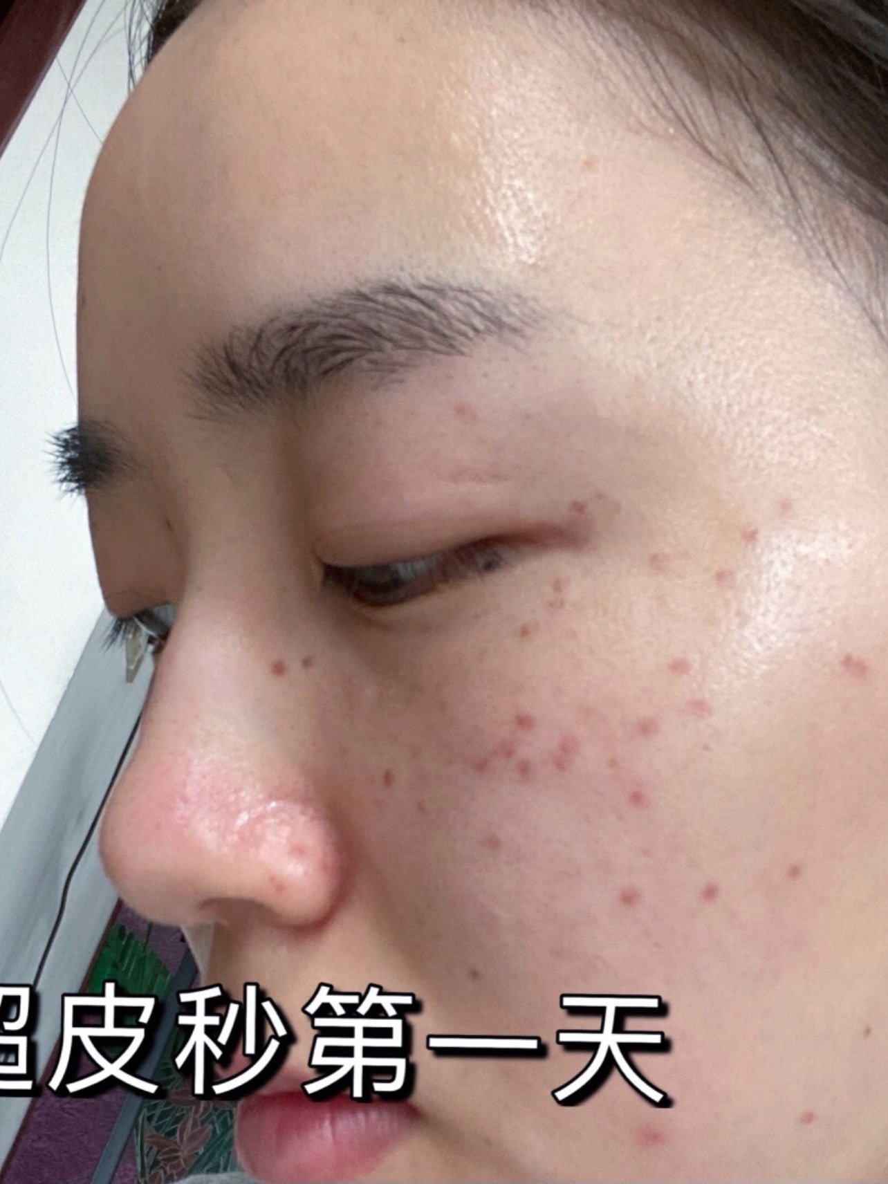 超皮秒全模式爆斑模式(一)记录一下第一次超皮秒10_圈子-新氧美容整形