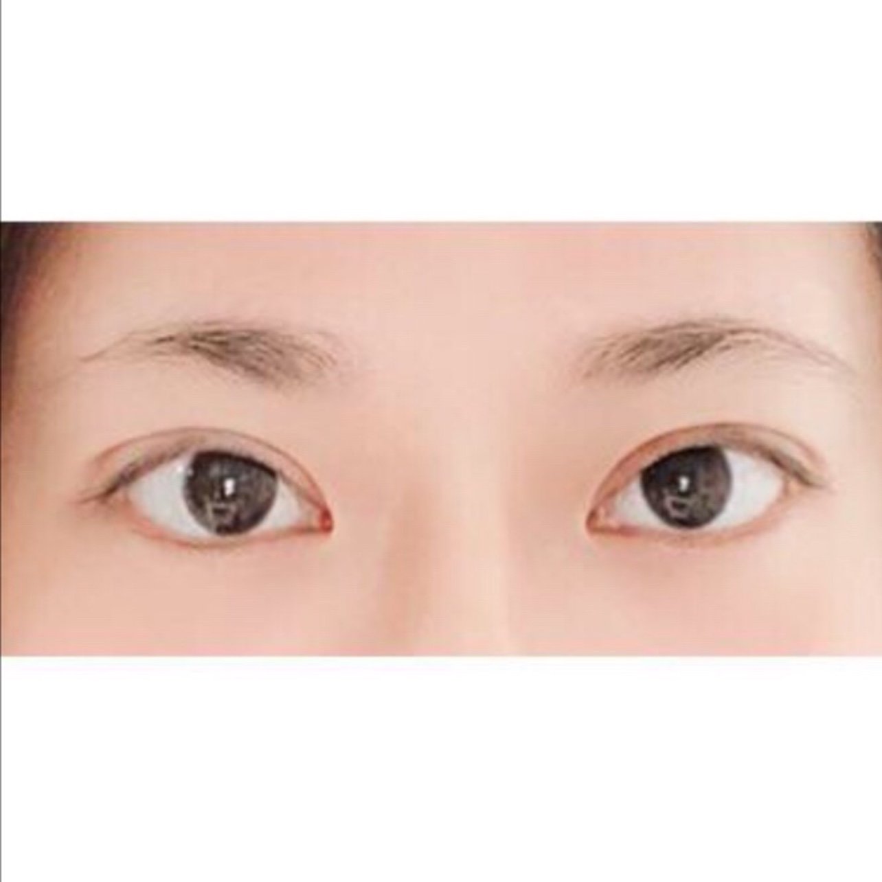 多层双眼皮修复后,7天恢复自然!