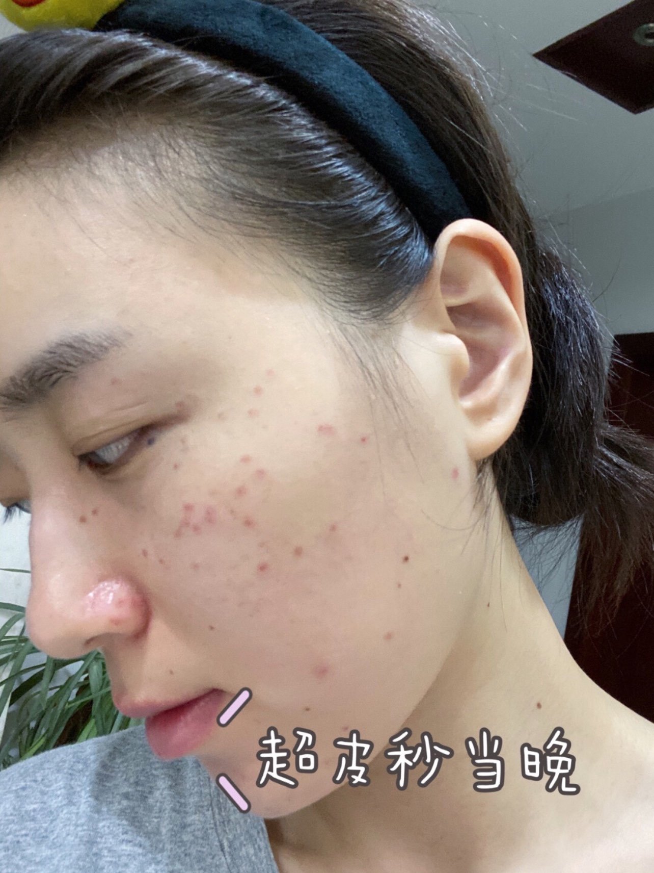 超皮秒全模式爆斑模式(一)记录一下第一次超皮秒10_圈子-新氧美容整形