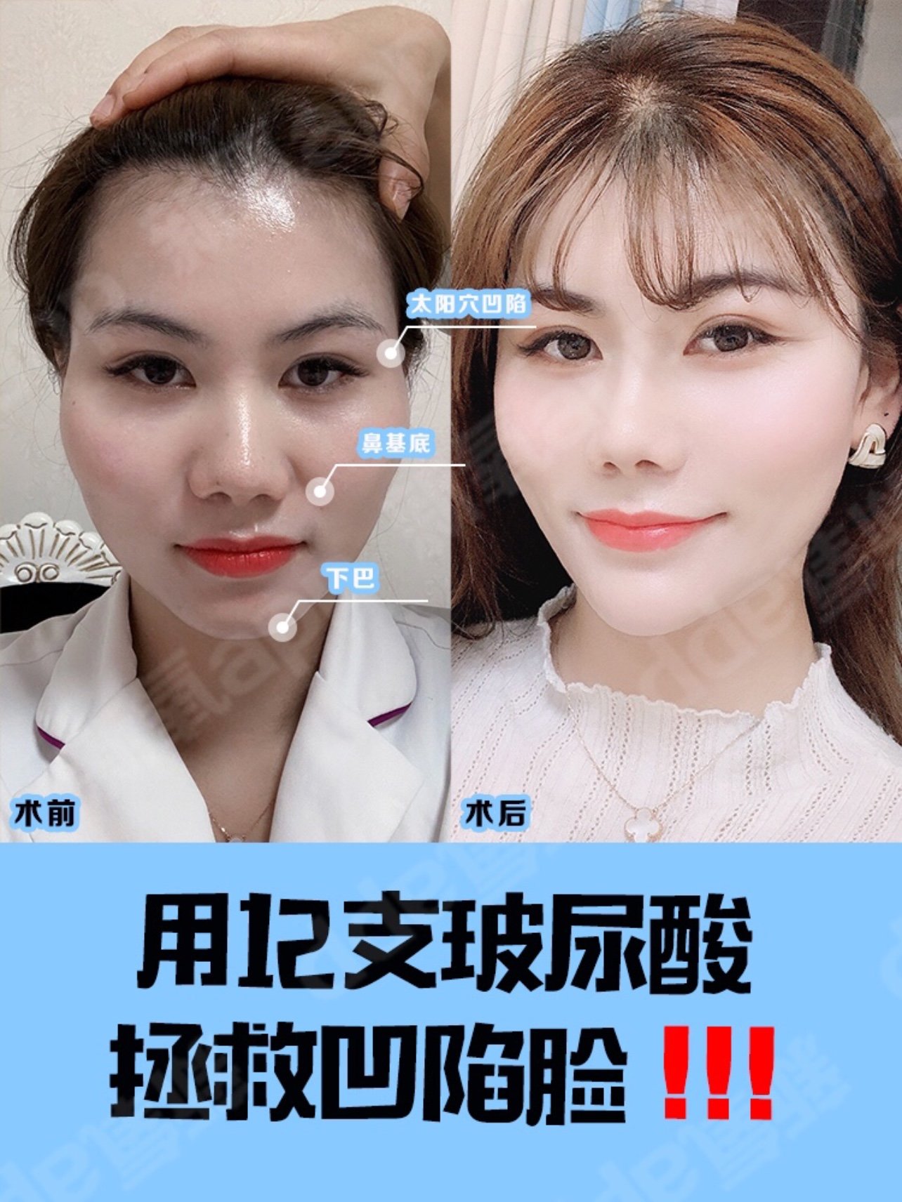 12支玻尿酸填充全脸拯救凹陷脸