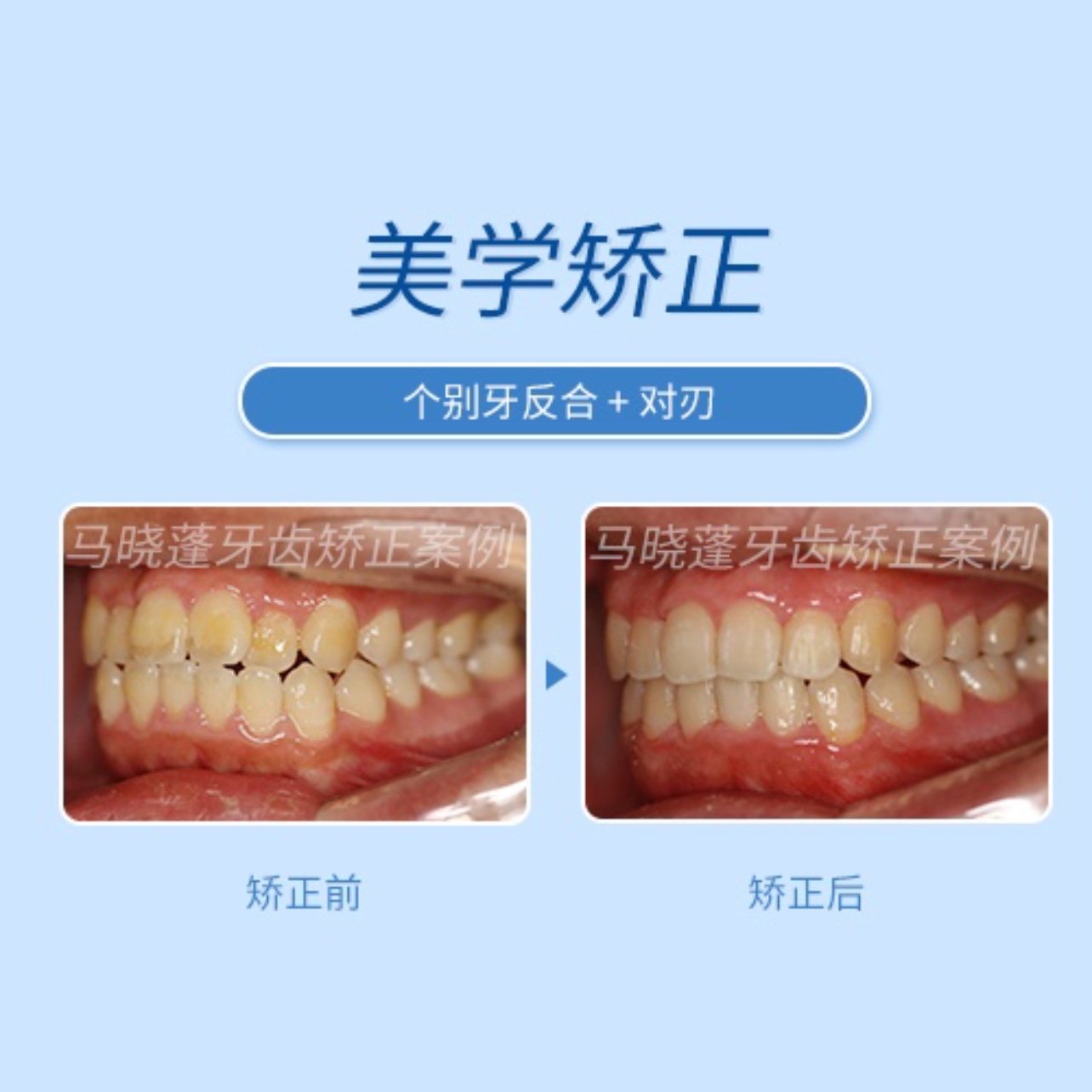 牙列拥挤个对刃隐形矫正案例分享
