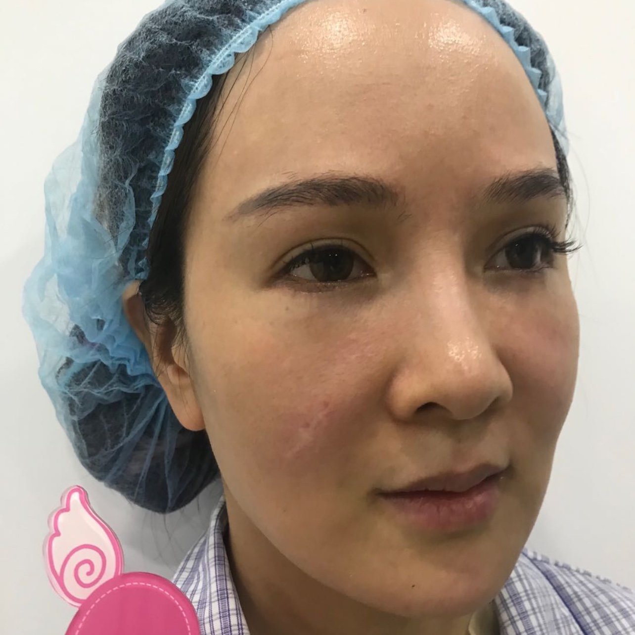 克拉美埋线提升术后第一天刚做完就看到了脸上的改变,_圈子-新氧美容