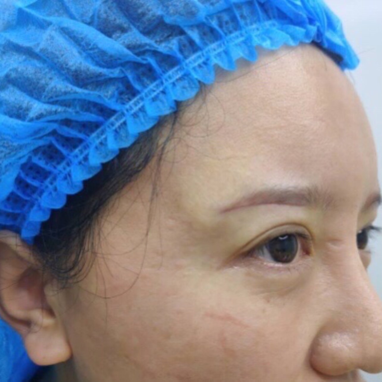 人都说我老的快,好难过,听朋友介绍说做提眉手术可以让下垂的眼皮提拉