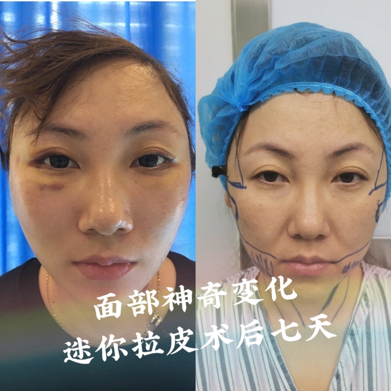 面部的神奇变化,迷你拉皮术后七天