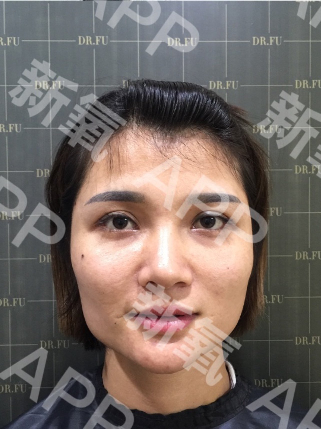 下颌术后46天,哈哈,现在超喜欢现在的脸型,翻开之_圈子-新氧美容整形