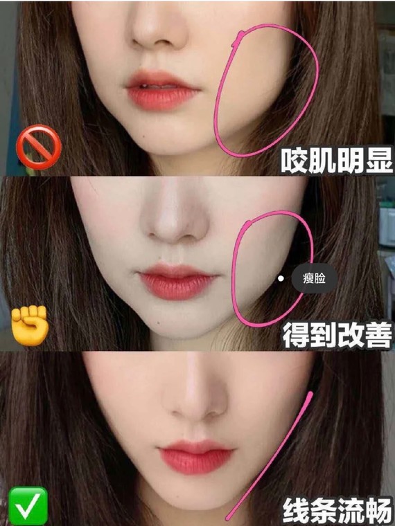 瘦咬肌大作战分享独家瘦脸小妙招!