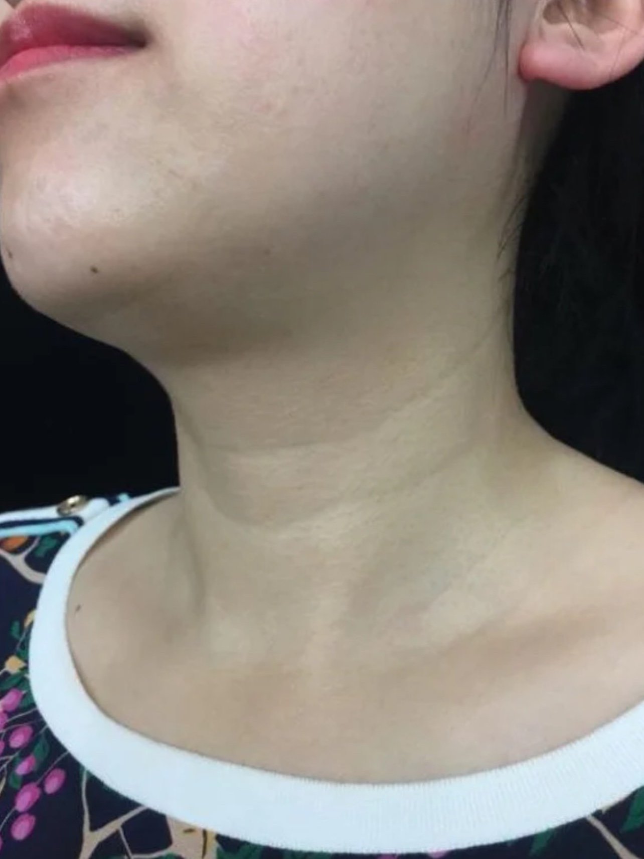 以前都不知道颈纹是什么,直到自己有了颈纹,才后知后_圈子-新氧美容