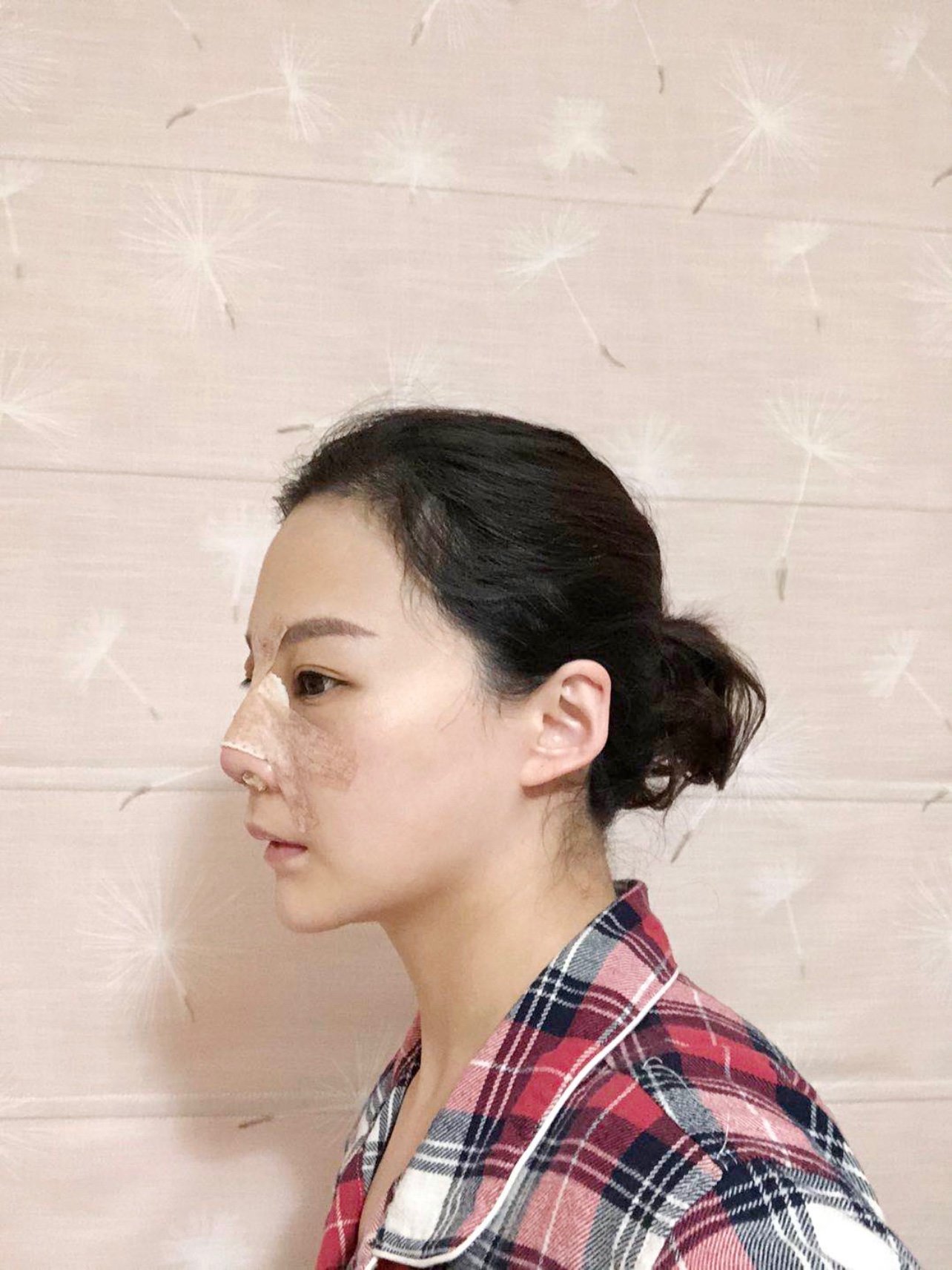 隆鼻术后第二天,有点难受,呼吸全靠嘴,鼻子上贴着胶_圈子-新氧美容