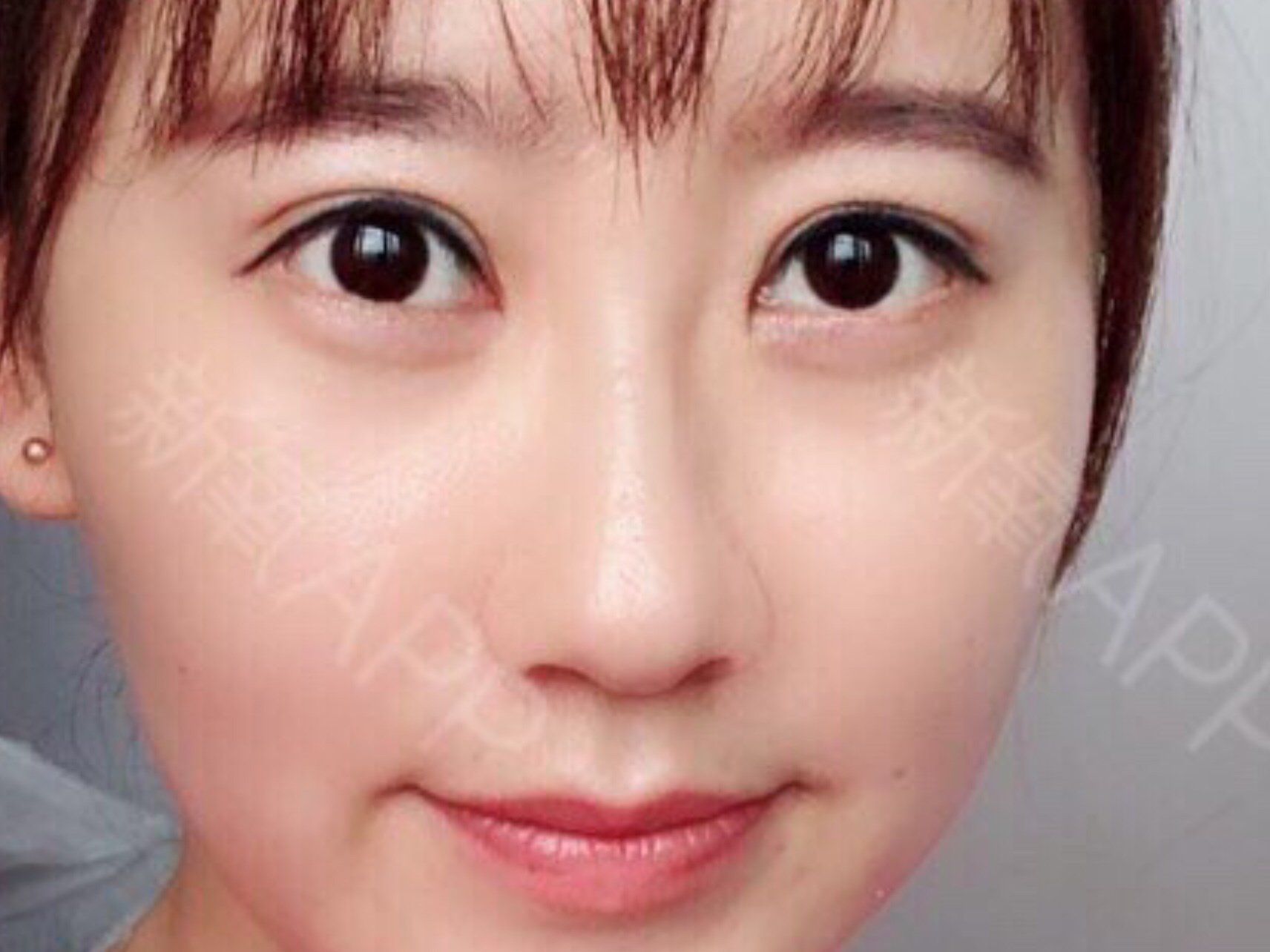 一年多前做的埋线双眼皮,结果慢慢松脱了,双眼皮也塌_圈子-新氧美容