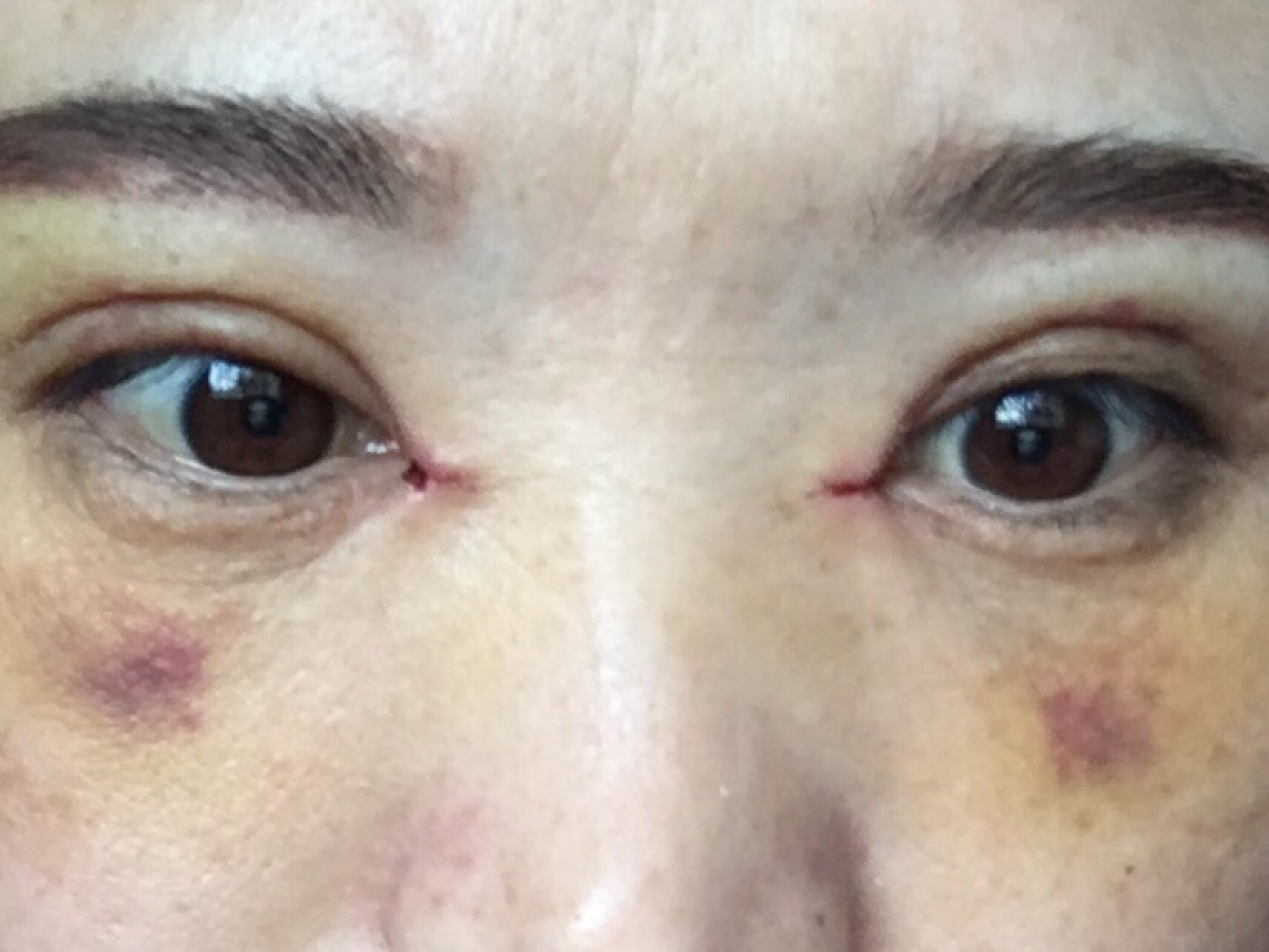 内眼角第7天了,摸起来硬,里面有个绿豆大的疙瘩,好_圈子-新氧美容整形