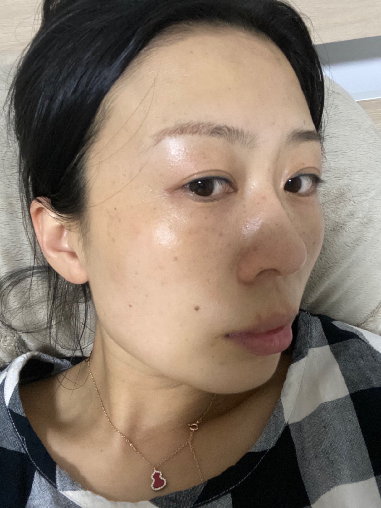 体验官日记超皮秒后2周记录---反黑?不存在的!_圈子-新氧美容整形