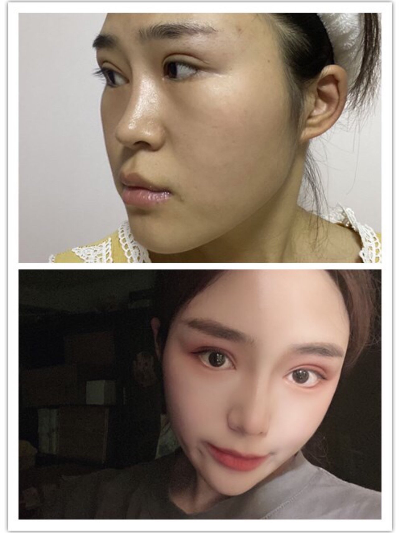 以前的塌塌鼻怎么弄都不好看,拍照的时候还要很可刻意_圈子-新氧美容